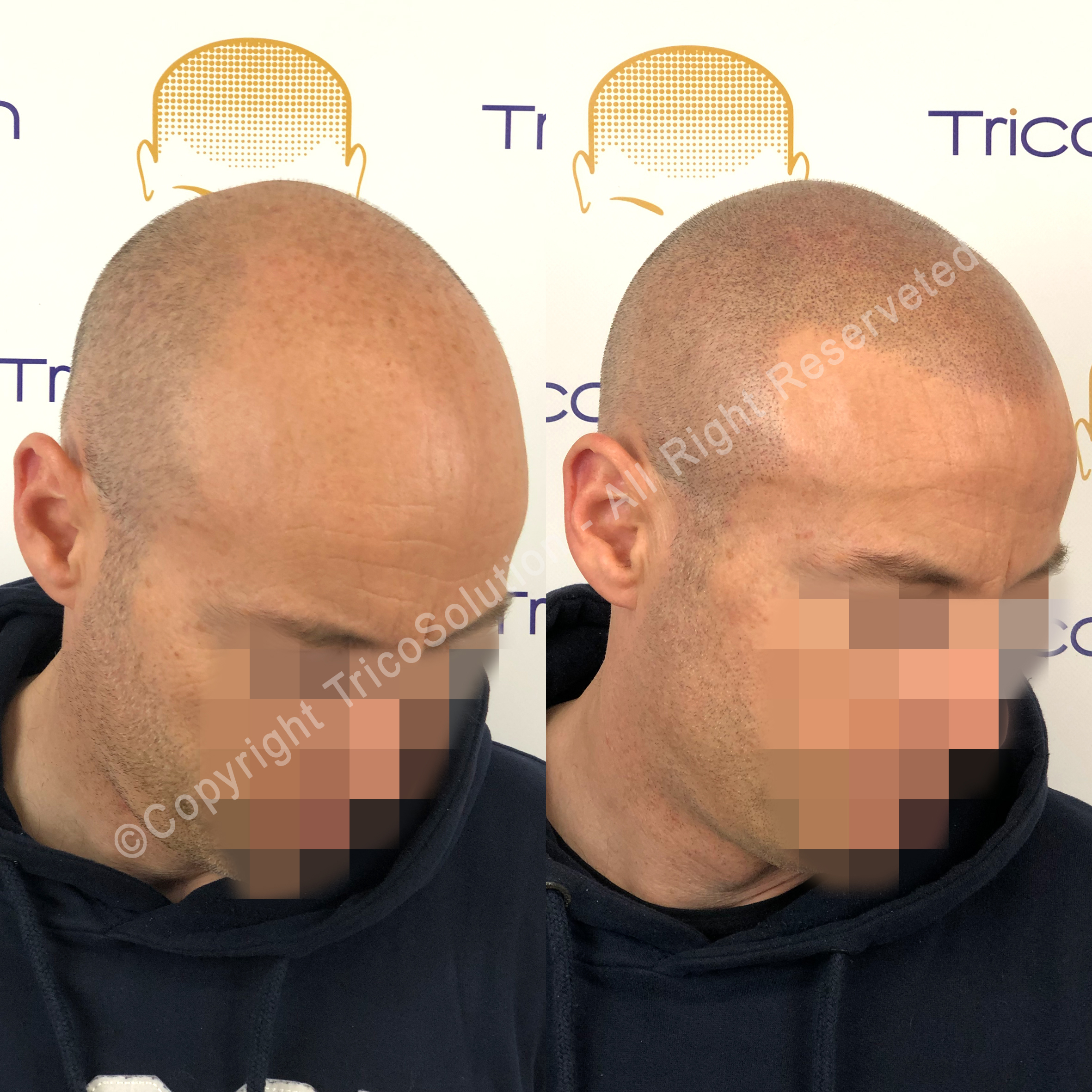 Effetto Rasato โ TricoSolution