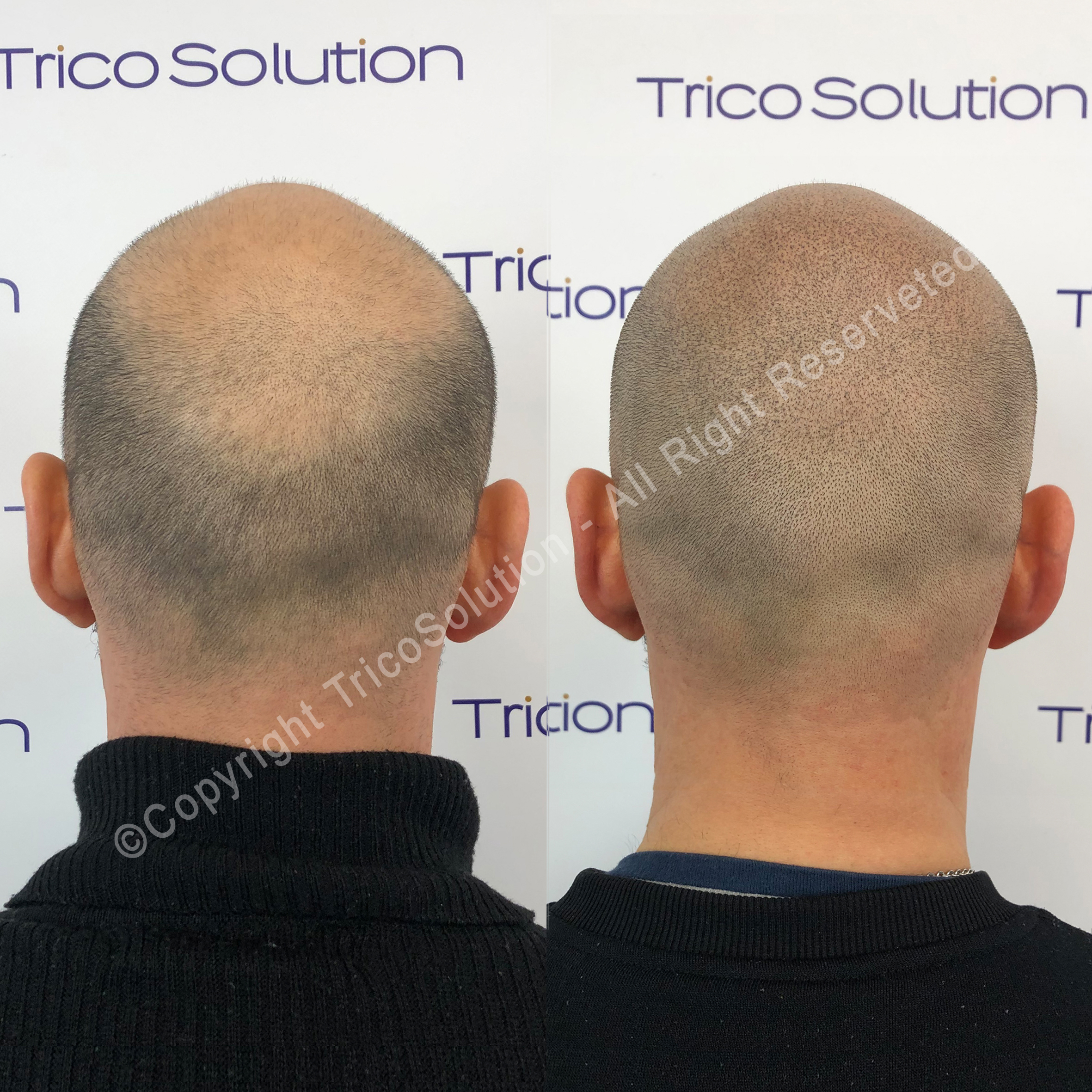 Effetto Rasato โ TricoSolution