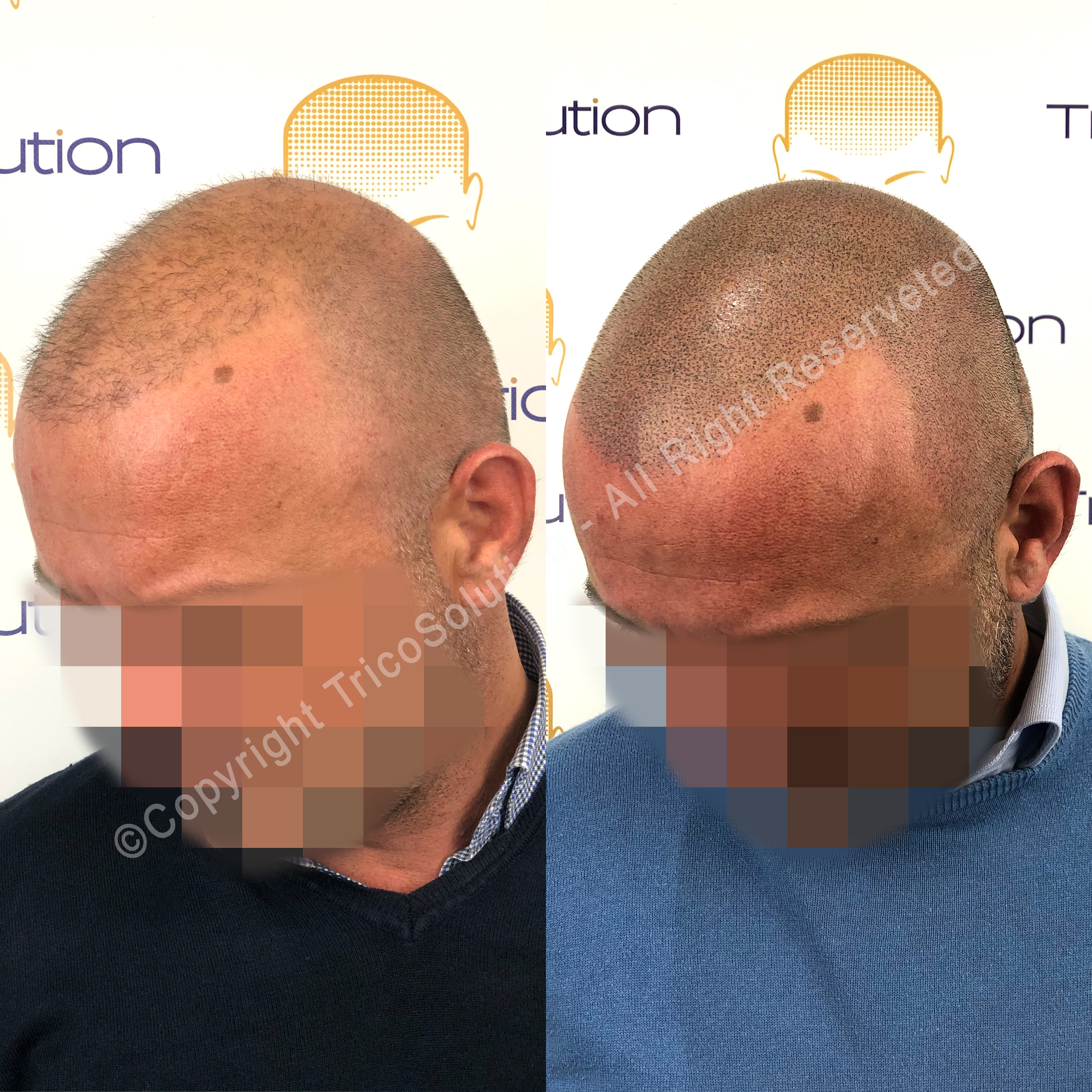Effetto Rasato โ TricoSolution
