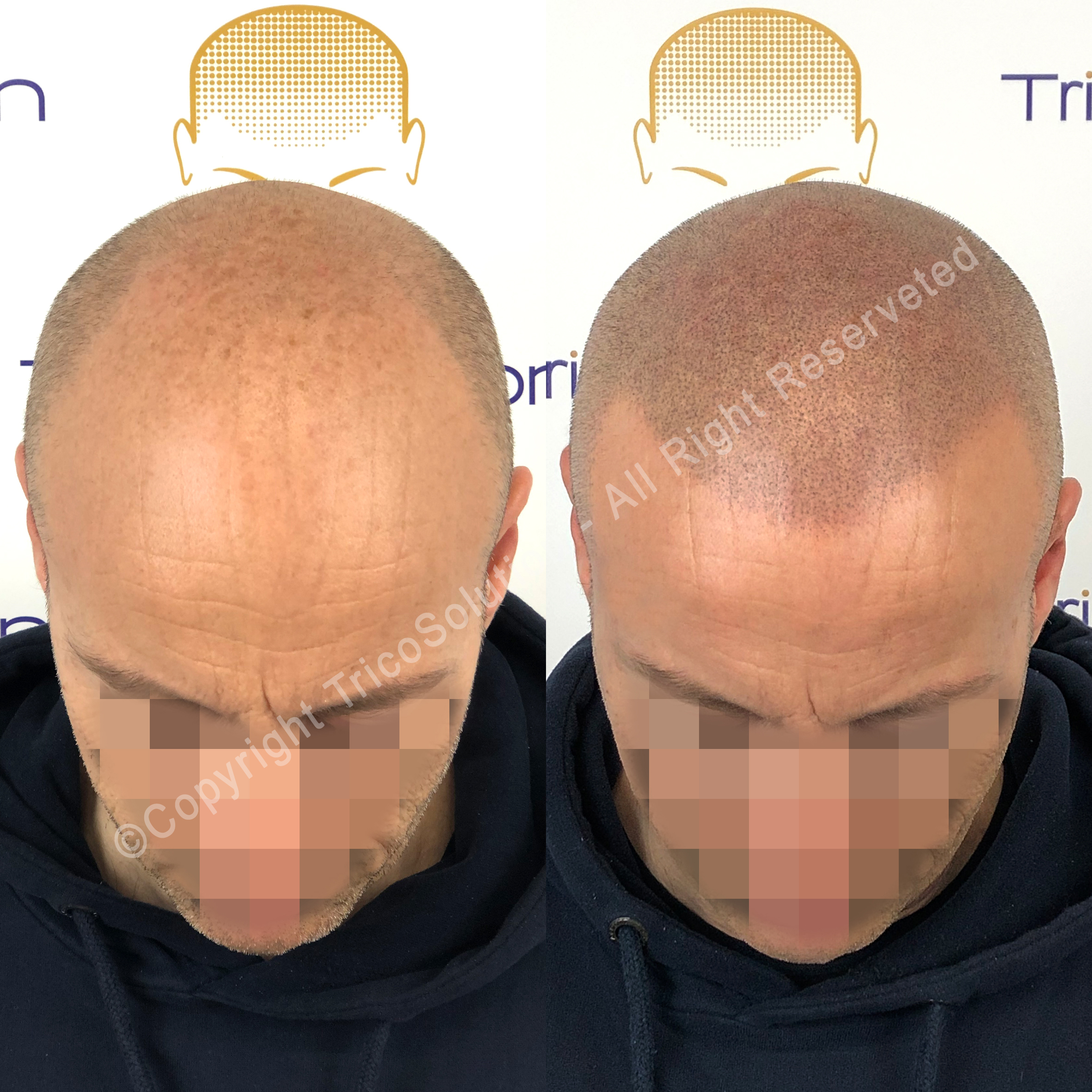 Effetto Rasato โ TricoSolution