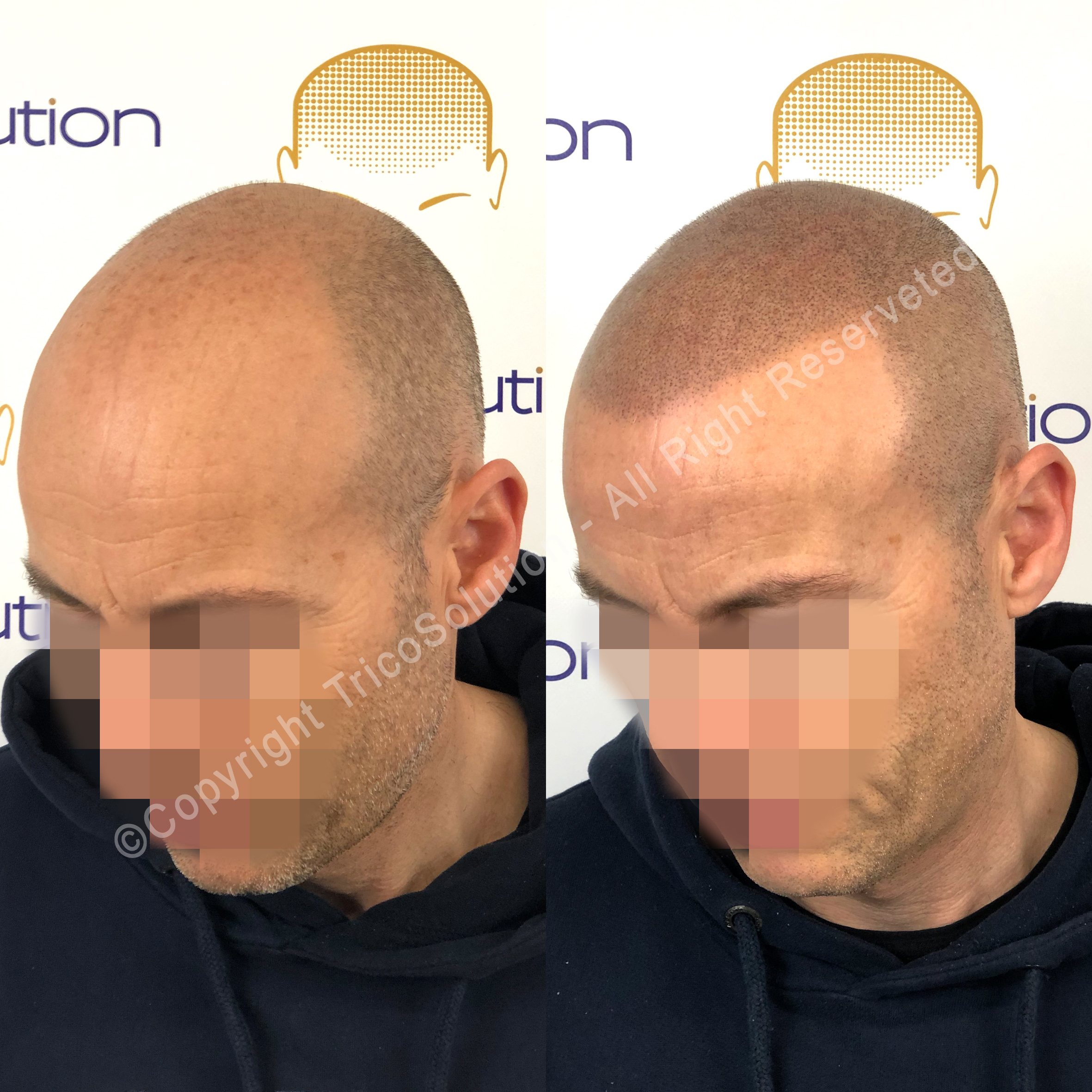 Effetto Rasato โ TricoSolution