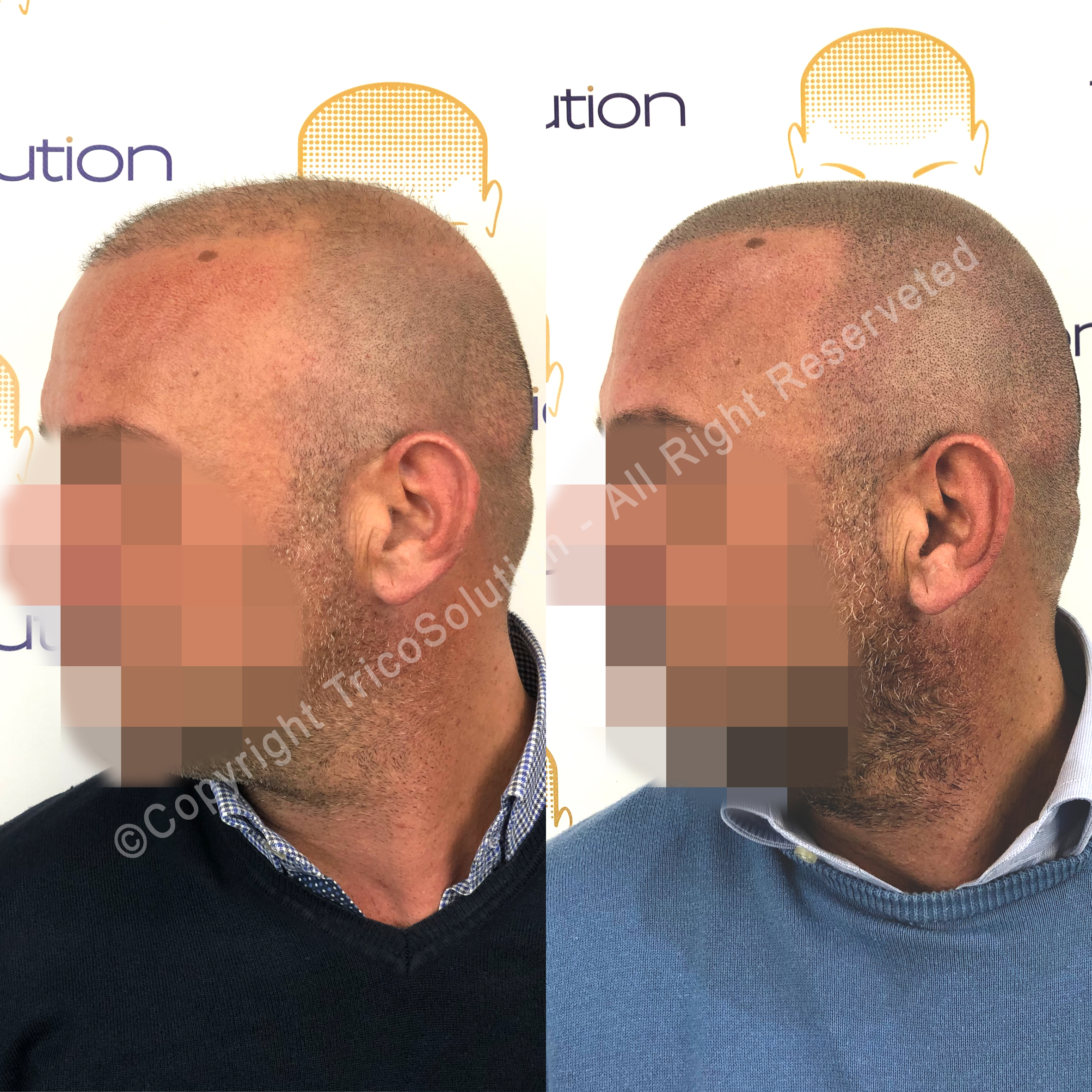 Effetto Rasato โ TricoSolution
