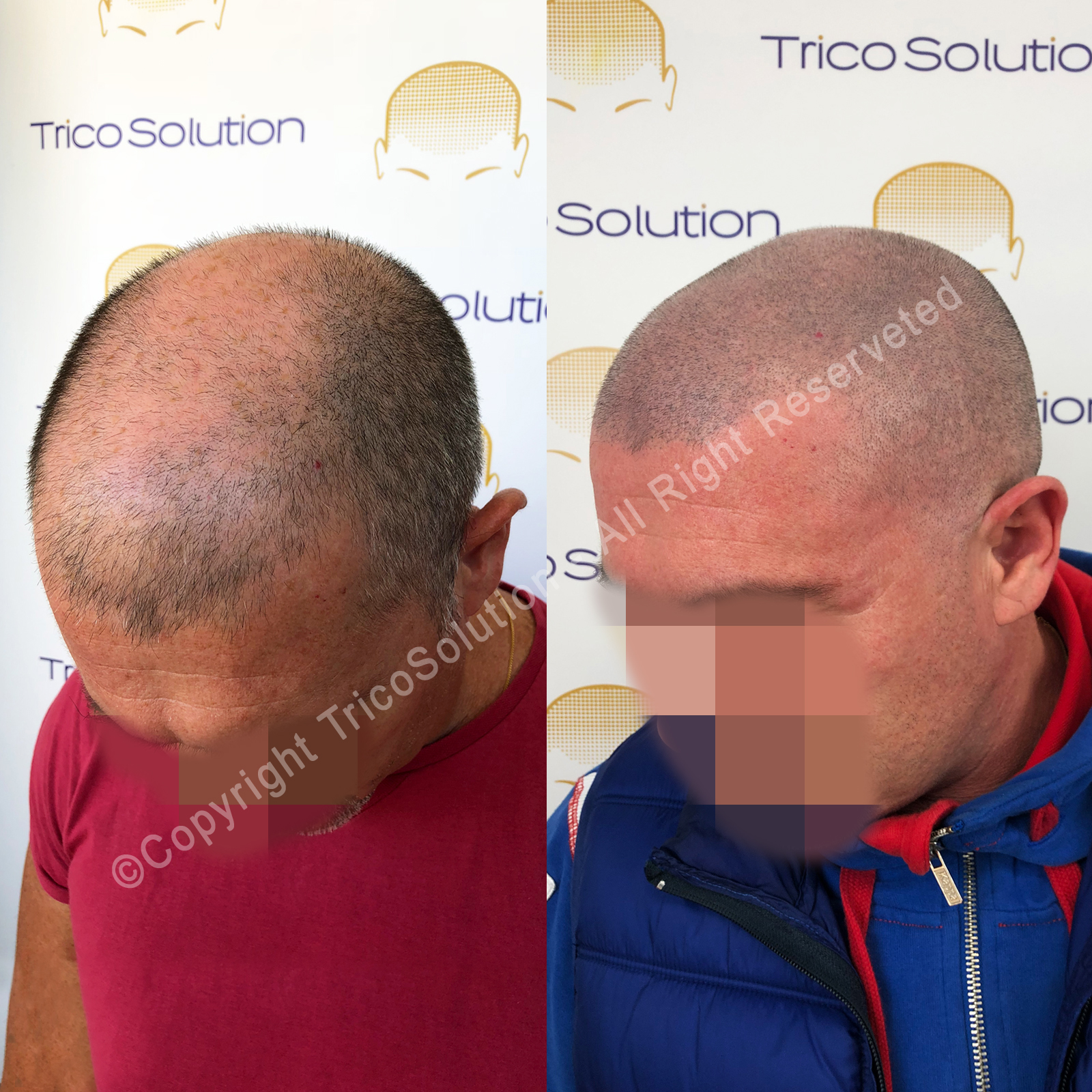 Effetto Rasato โ TricoSolution