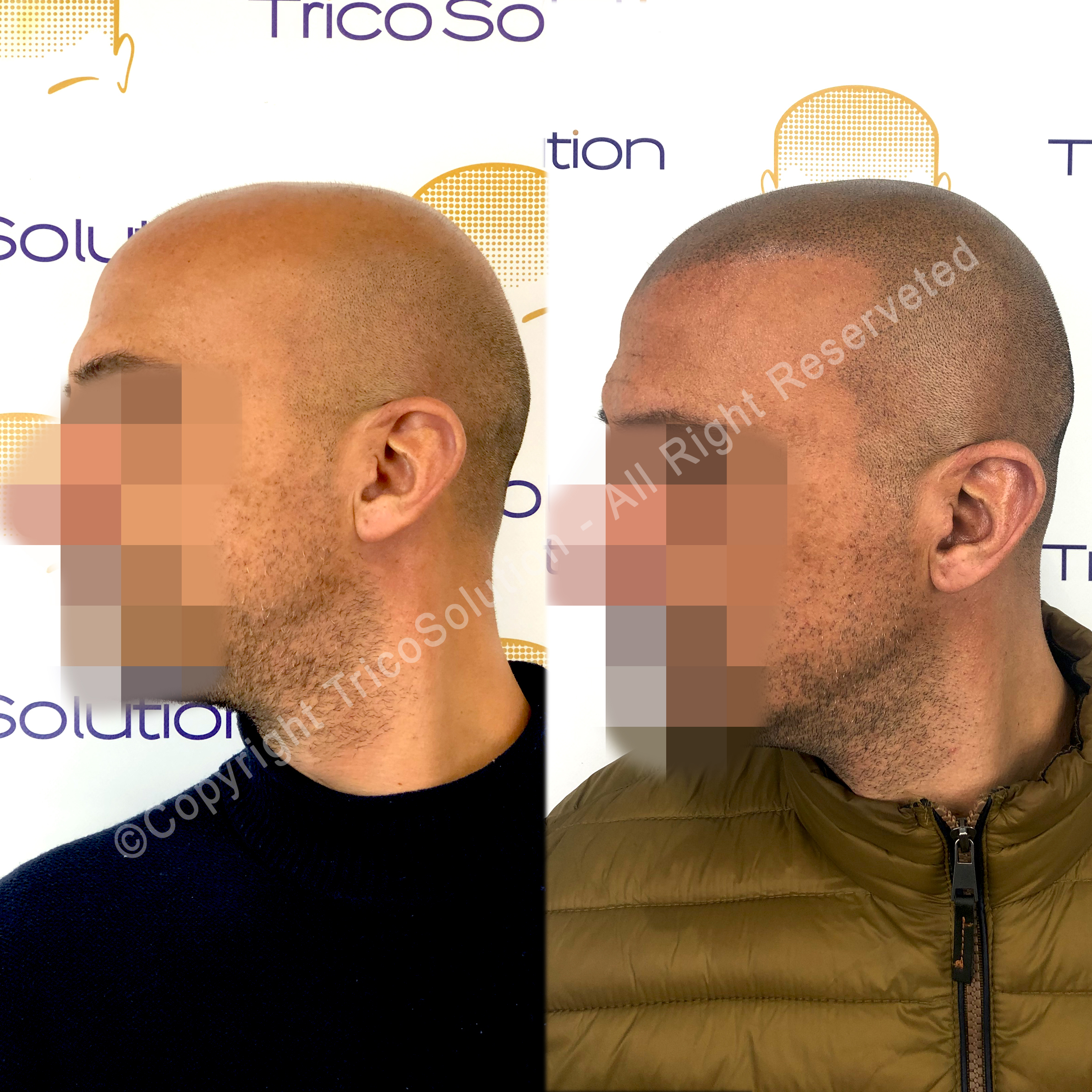 Effetto Rasato โ TricoSolution