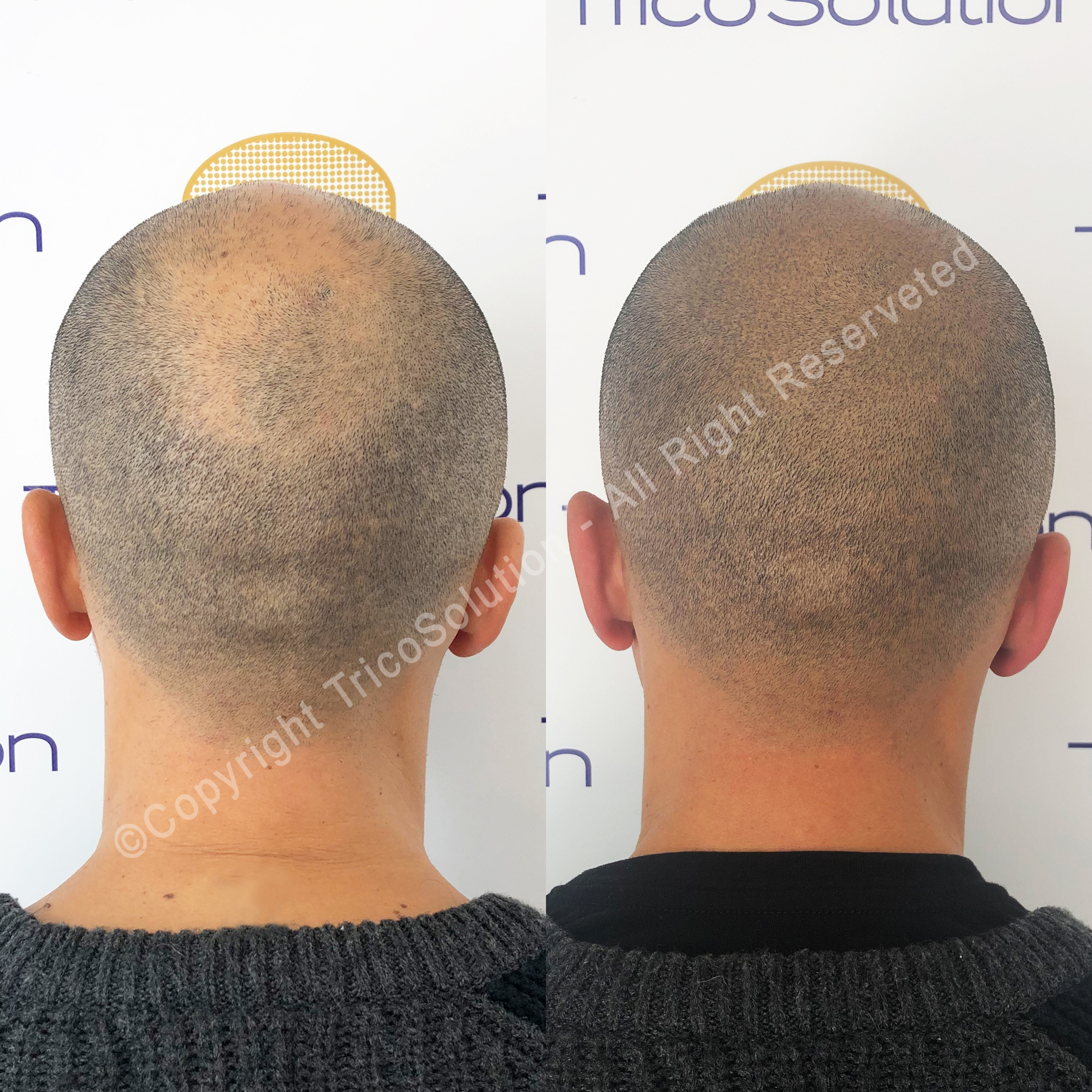 Effetto Rasato โ TricoSolution