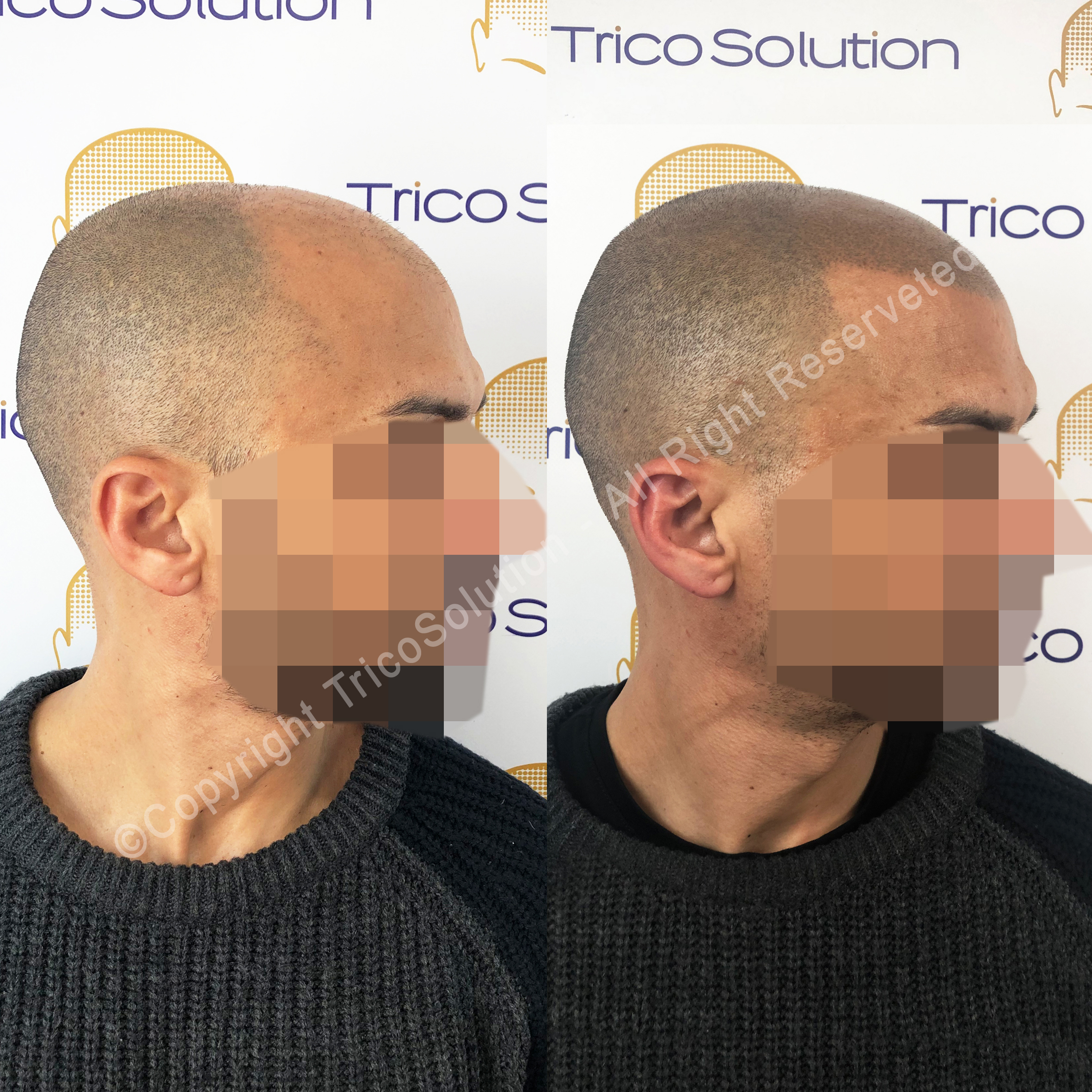 Effetto Rasato โ TricoSolution