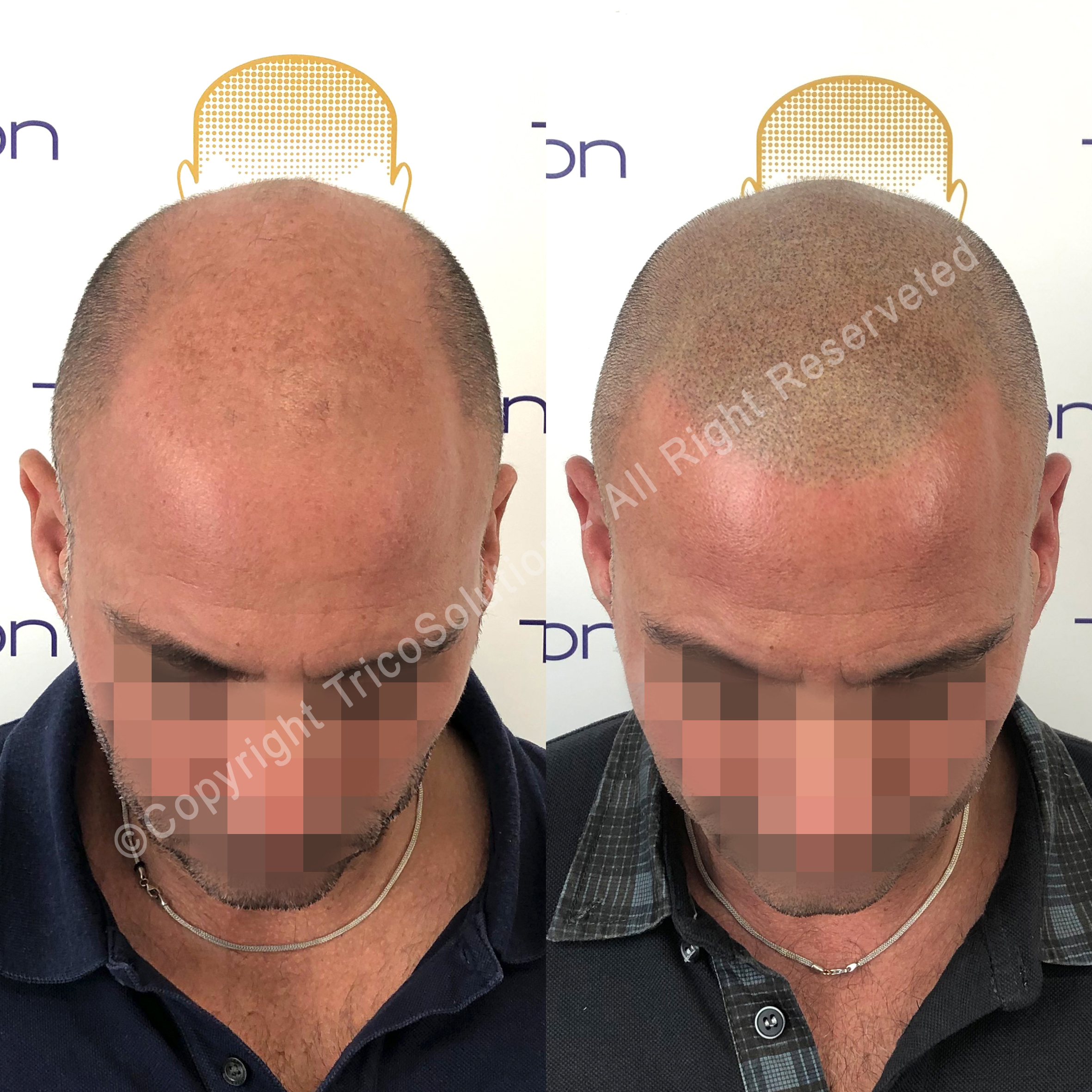 Effetto Rasato โ TricoSolution
