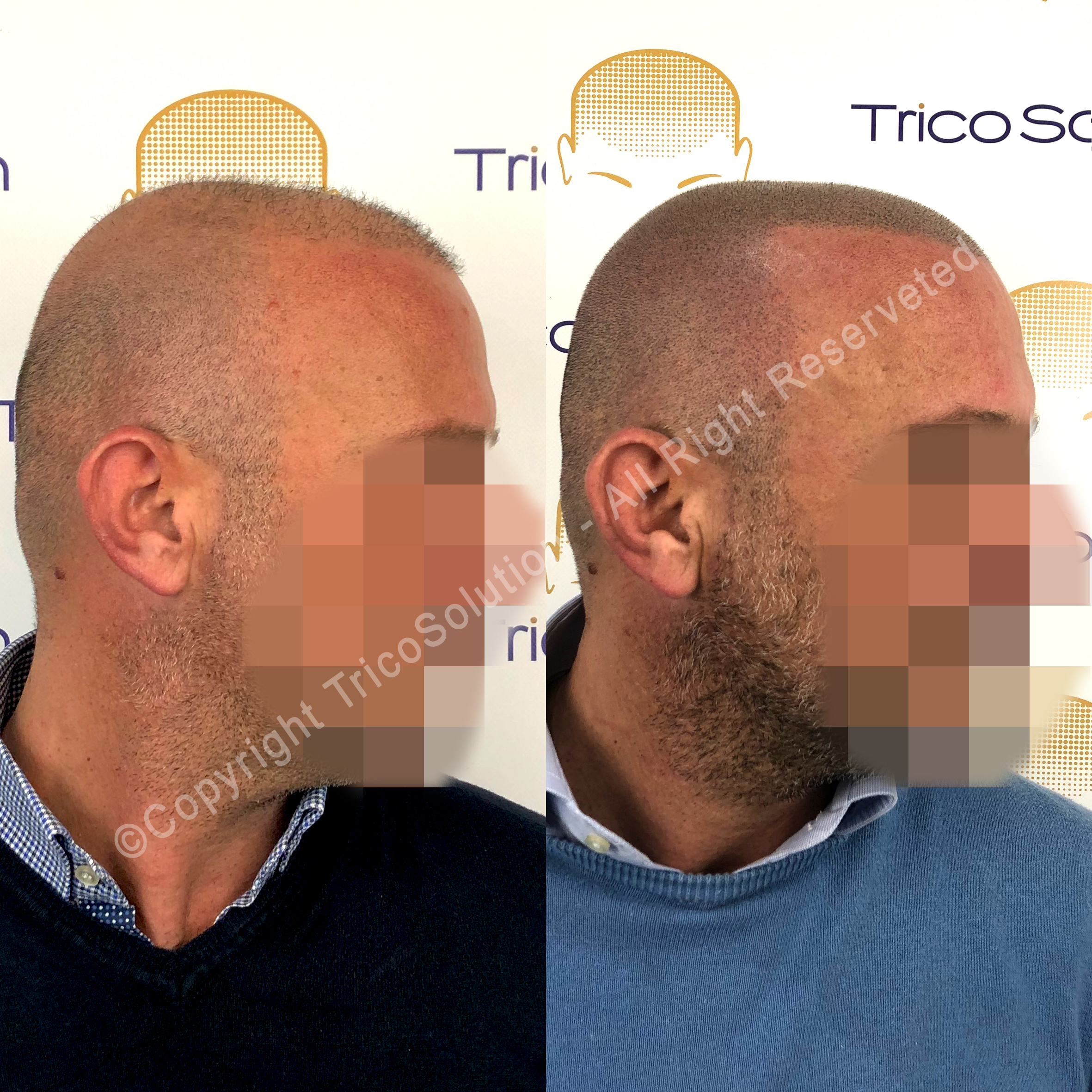 Effetto Rasato โ TricoSolution