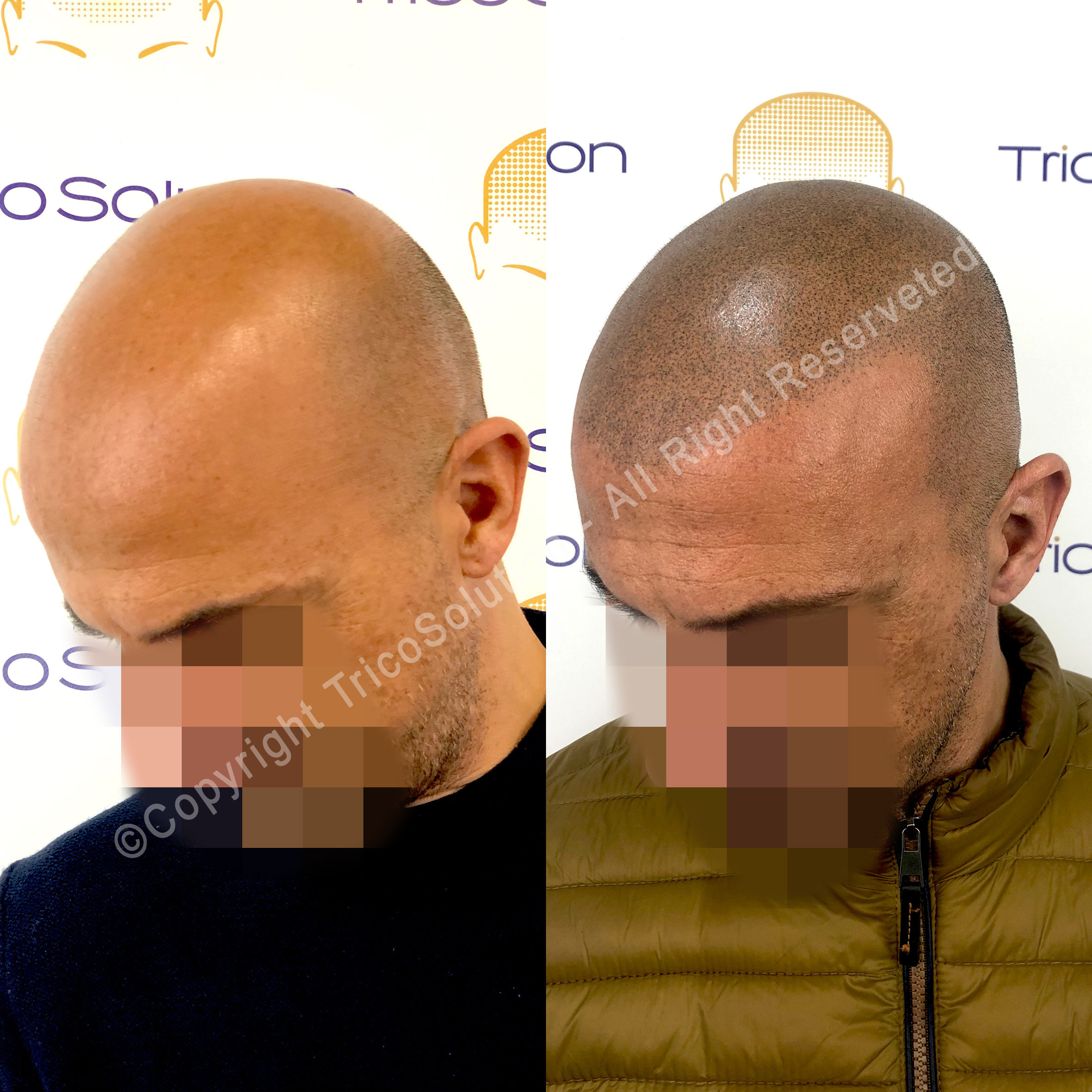 Effetto Rasato โ TricoSolution