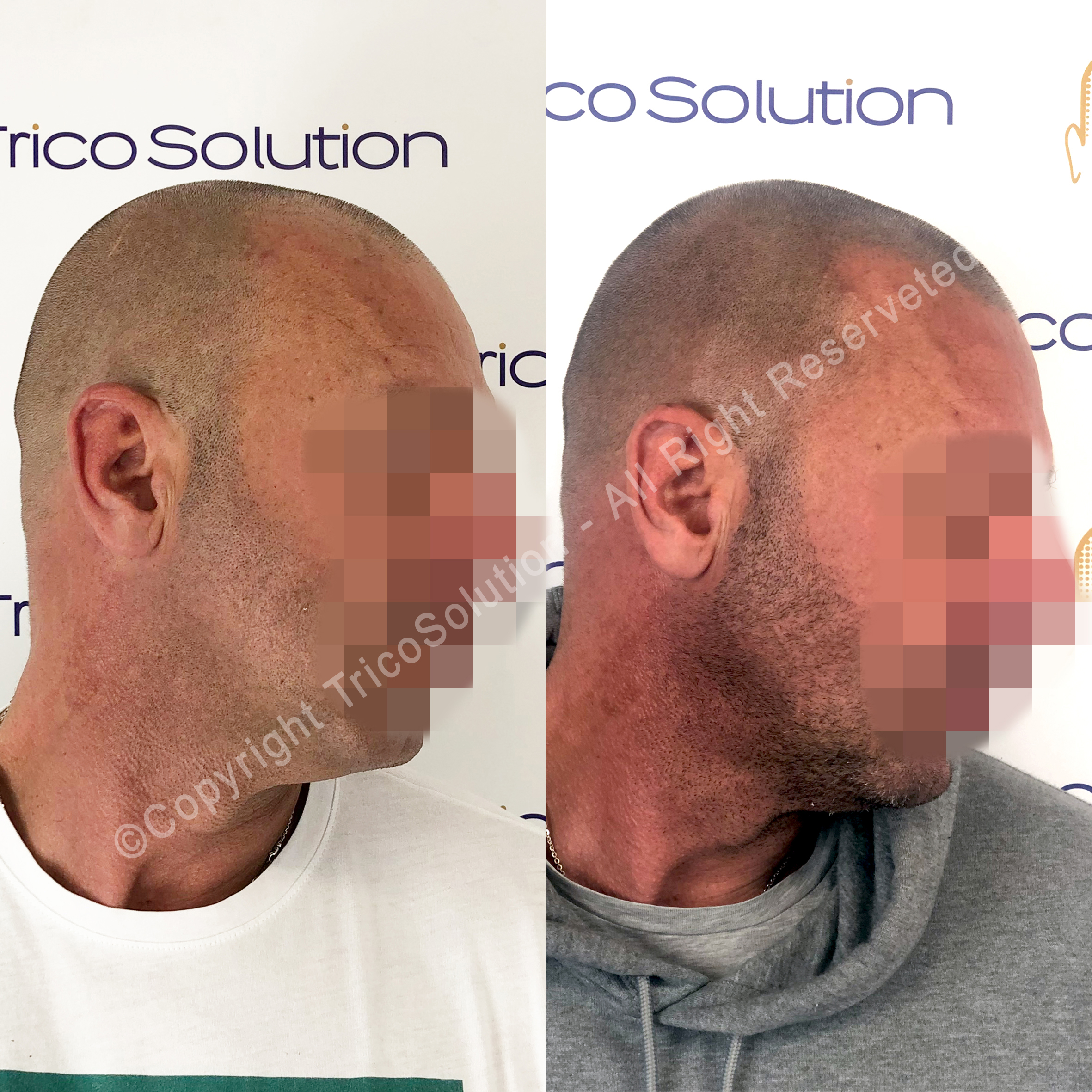 Effetto Rasato โ TricoSolution