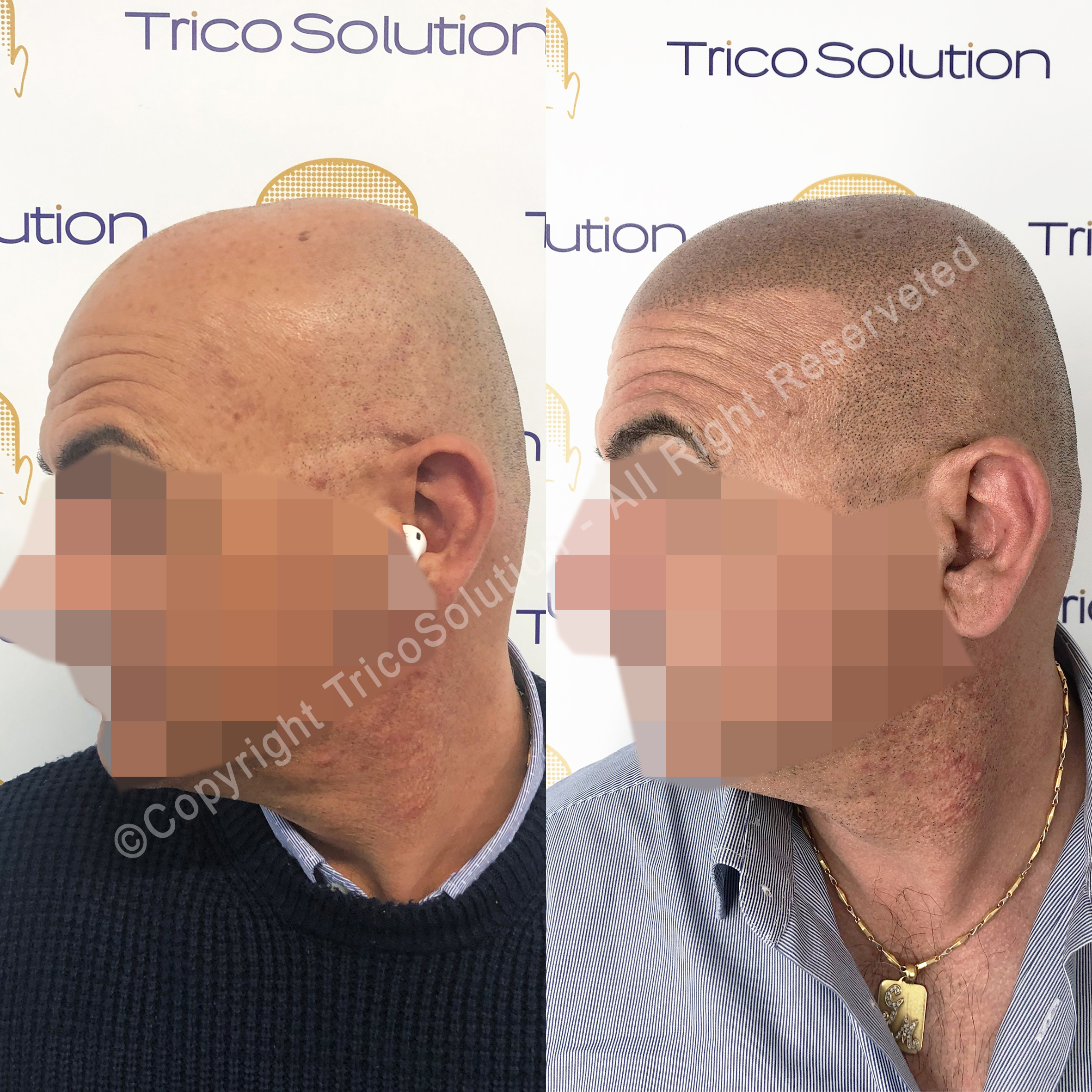 Effetto Rasato โ TricoSolution