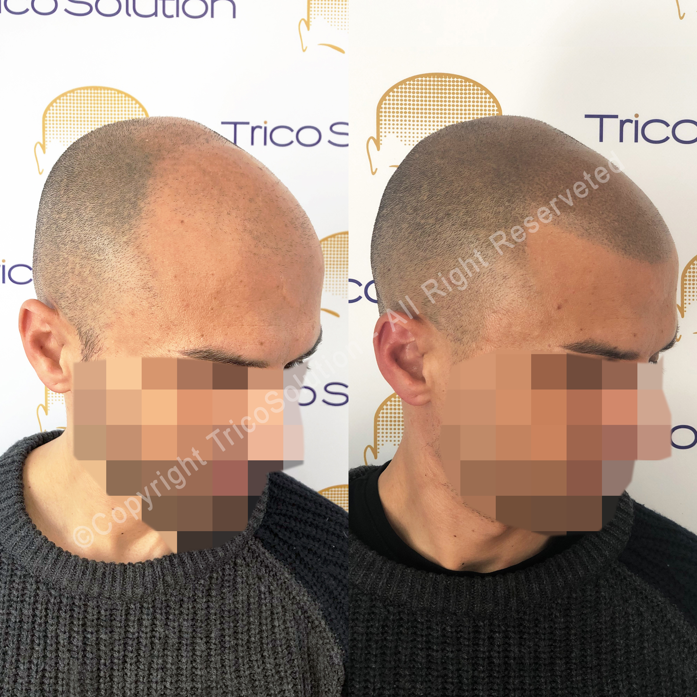 Effetto Rasato โ TricoSolution
