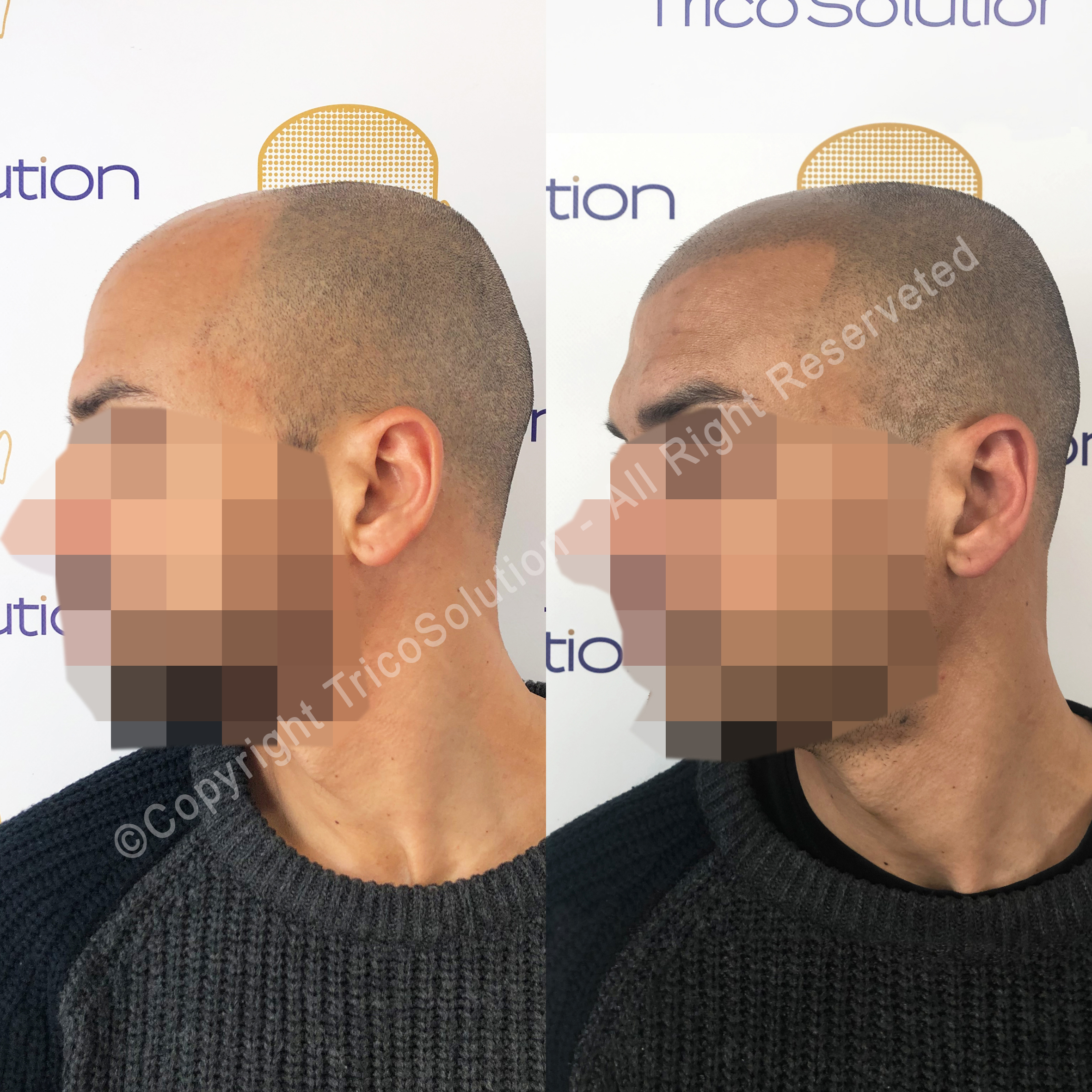 Effetto Rasato โ TricoSolution