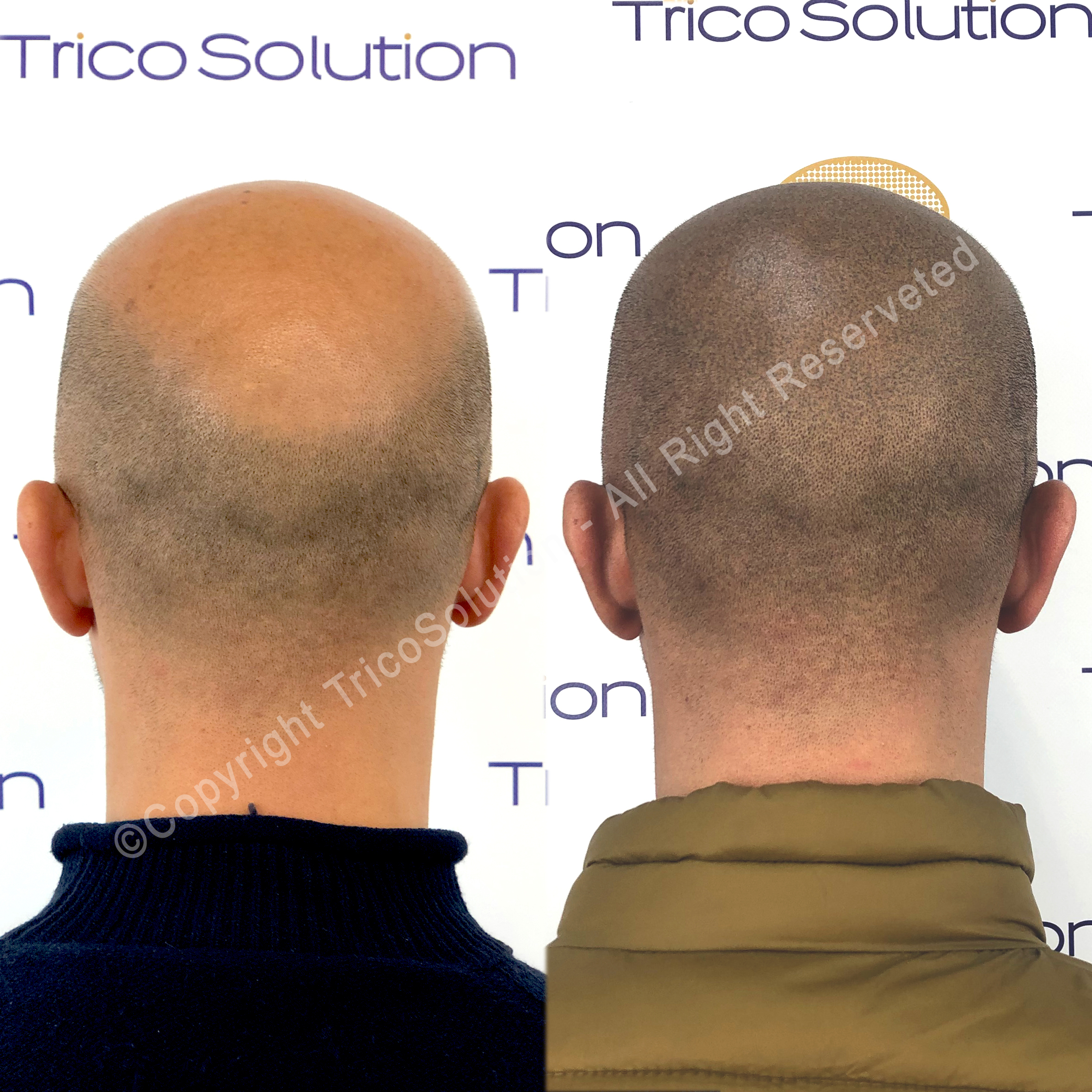 Effetto Rasato โ TricoSolution