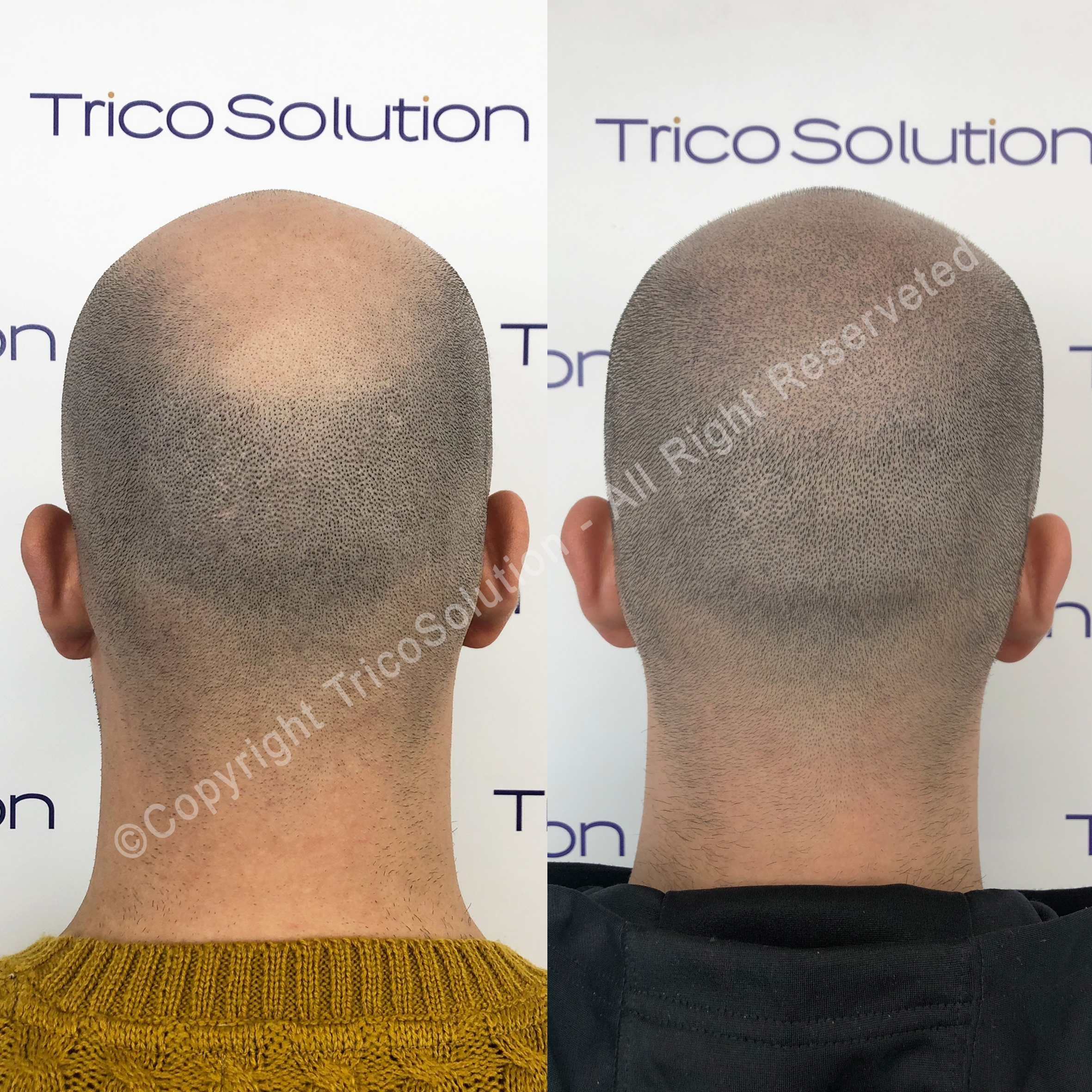 Effetto Rasato โ TricoSolution