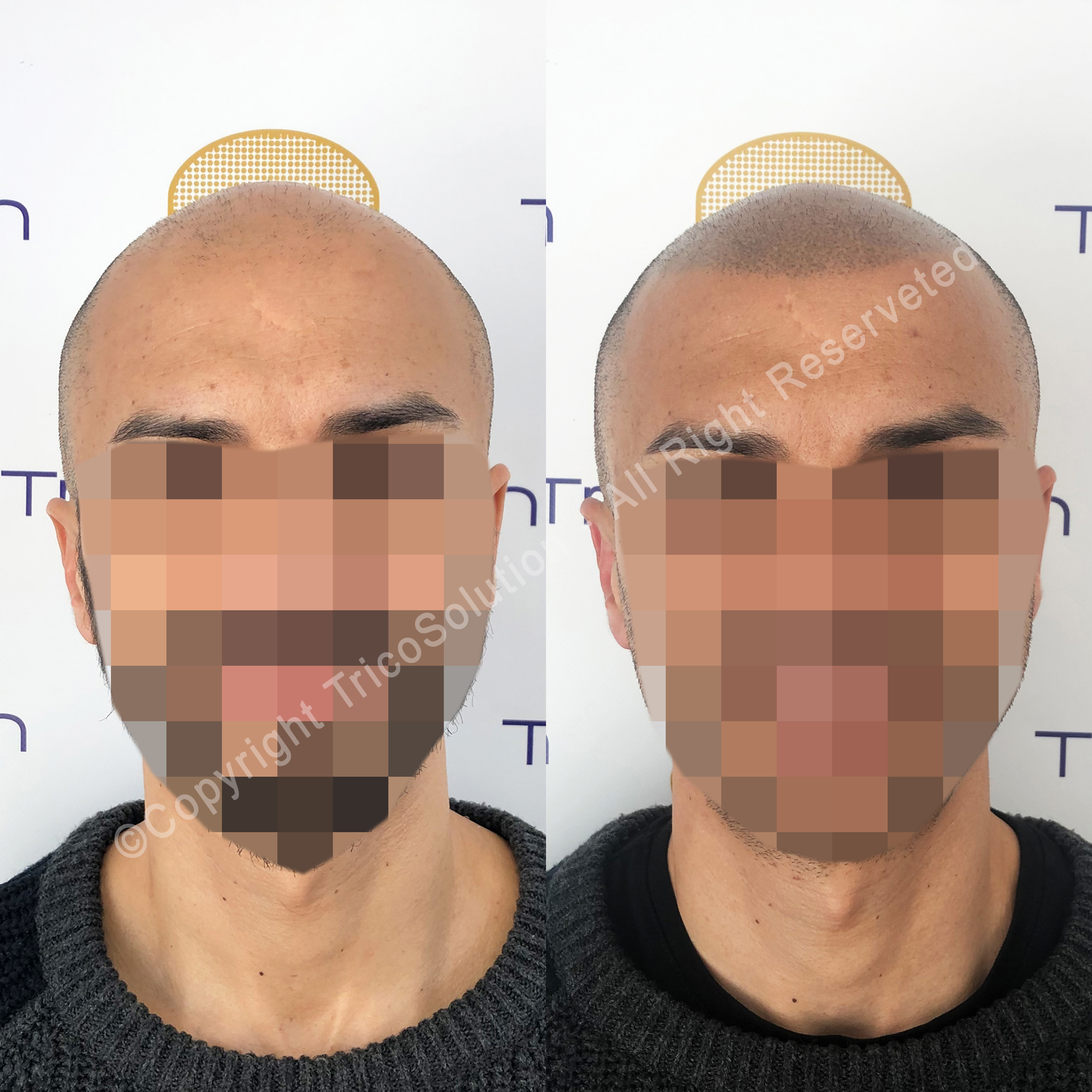 Effetto Rasato โ TricoSolution