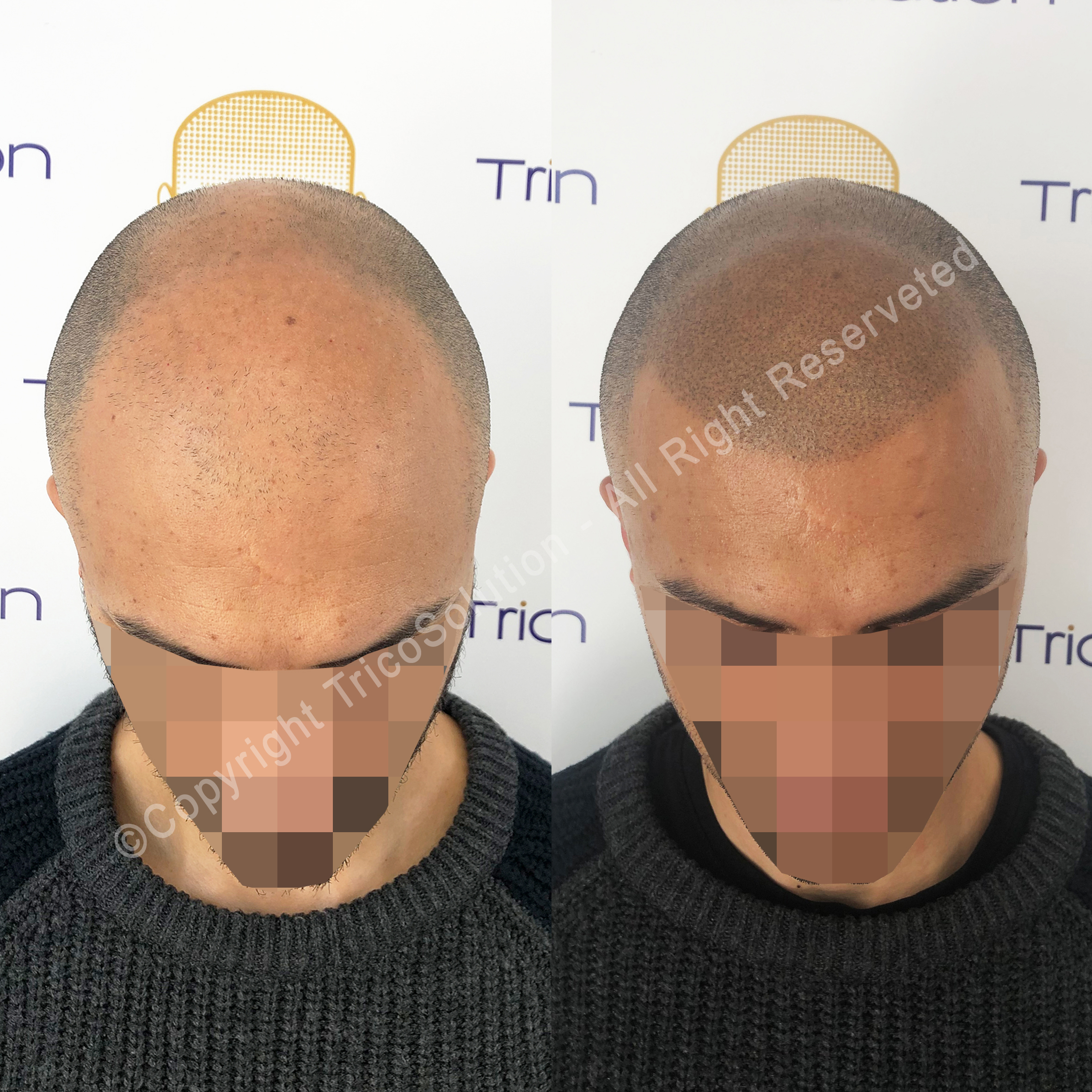 Effetto Rasato โ TricoSolution