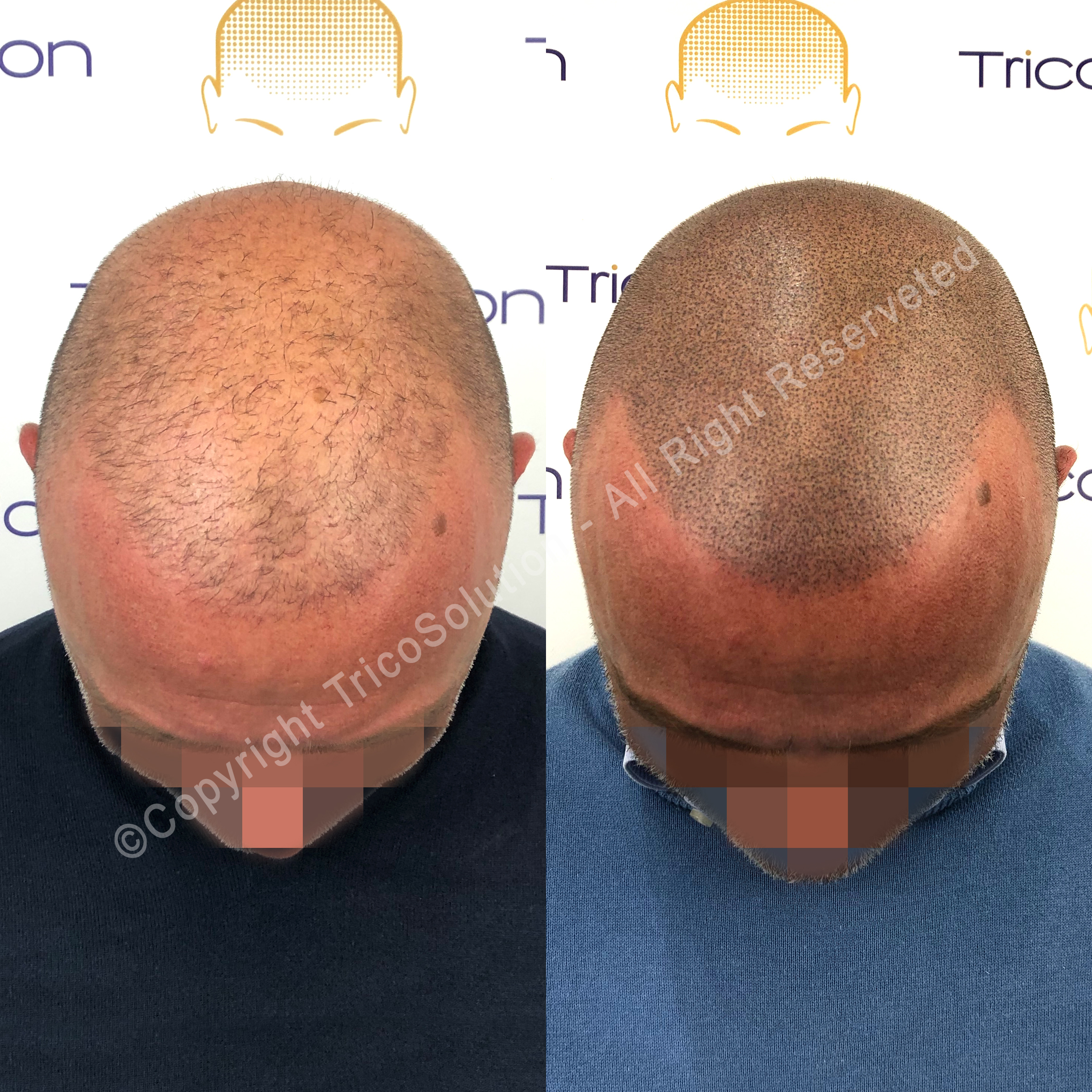 Effetto Rasato โ TricoSolution