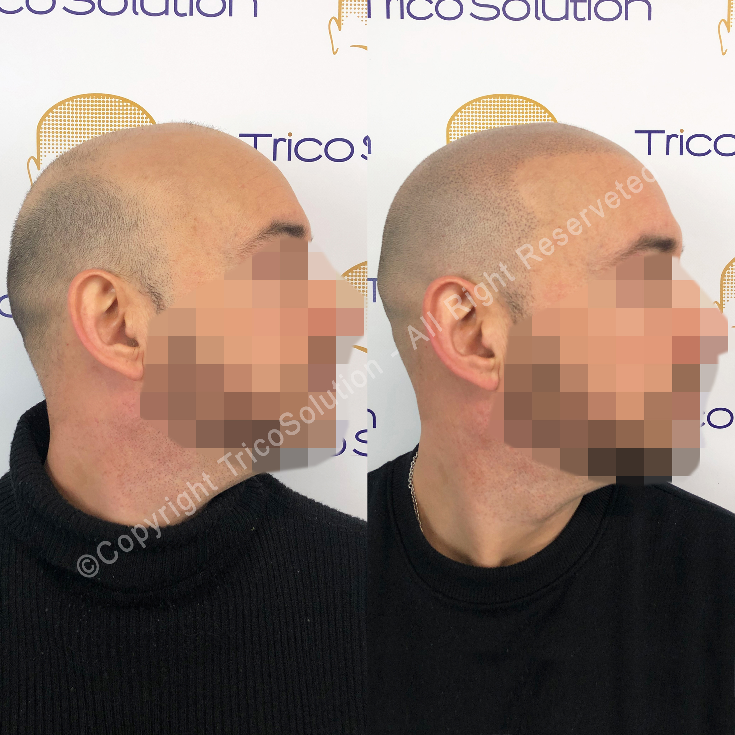 Effetto Rasato โ TricoSolution