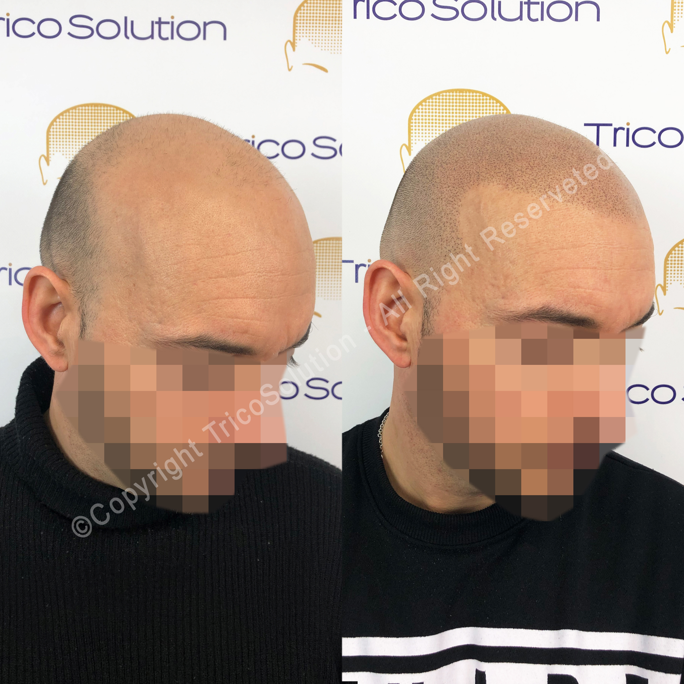 Effetto Rasato โ TricoSolution