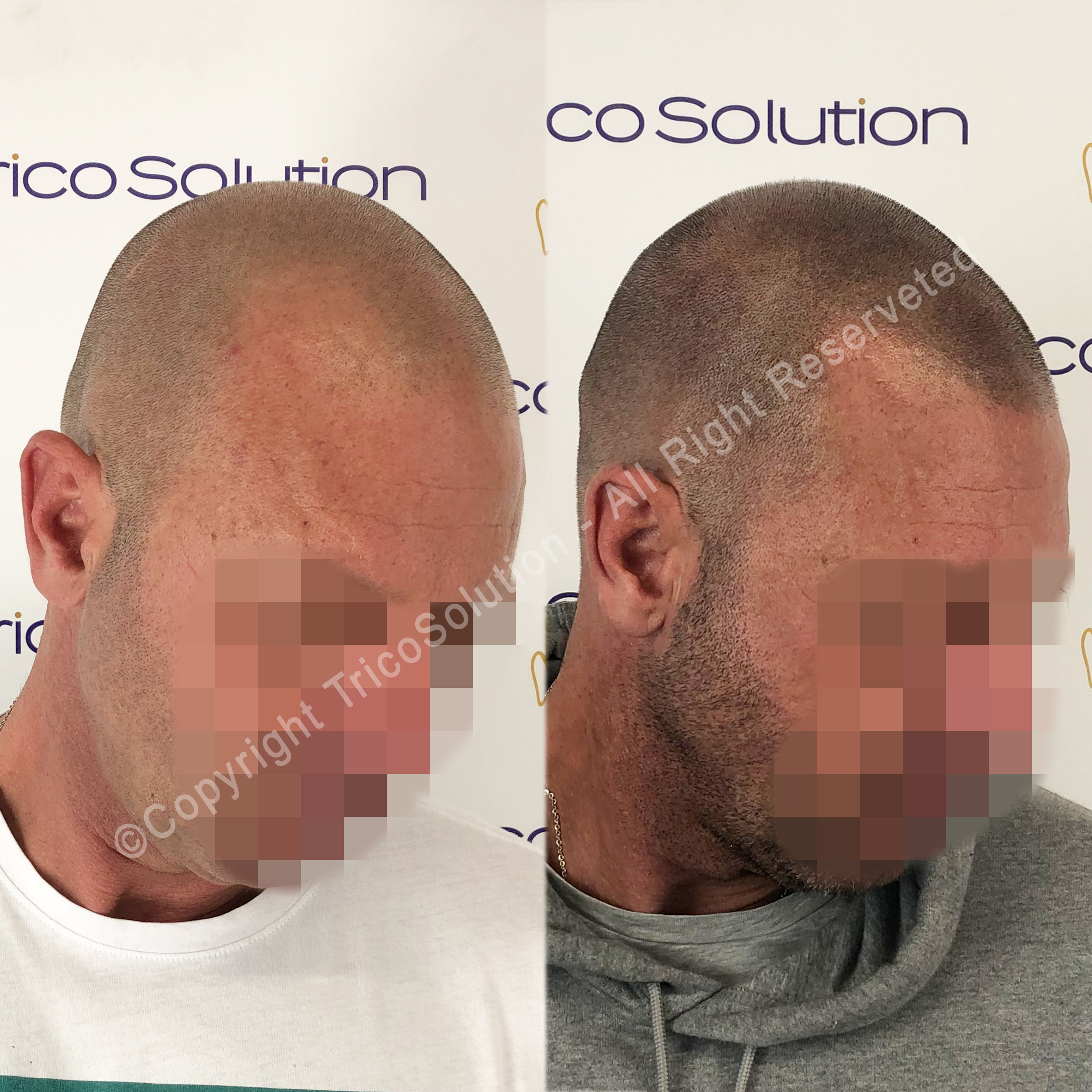 Effetto Rasato โ TricoSolution