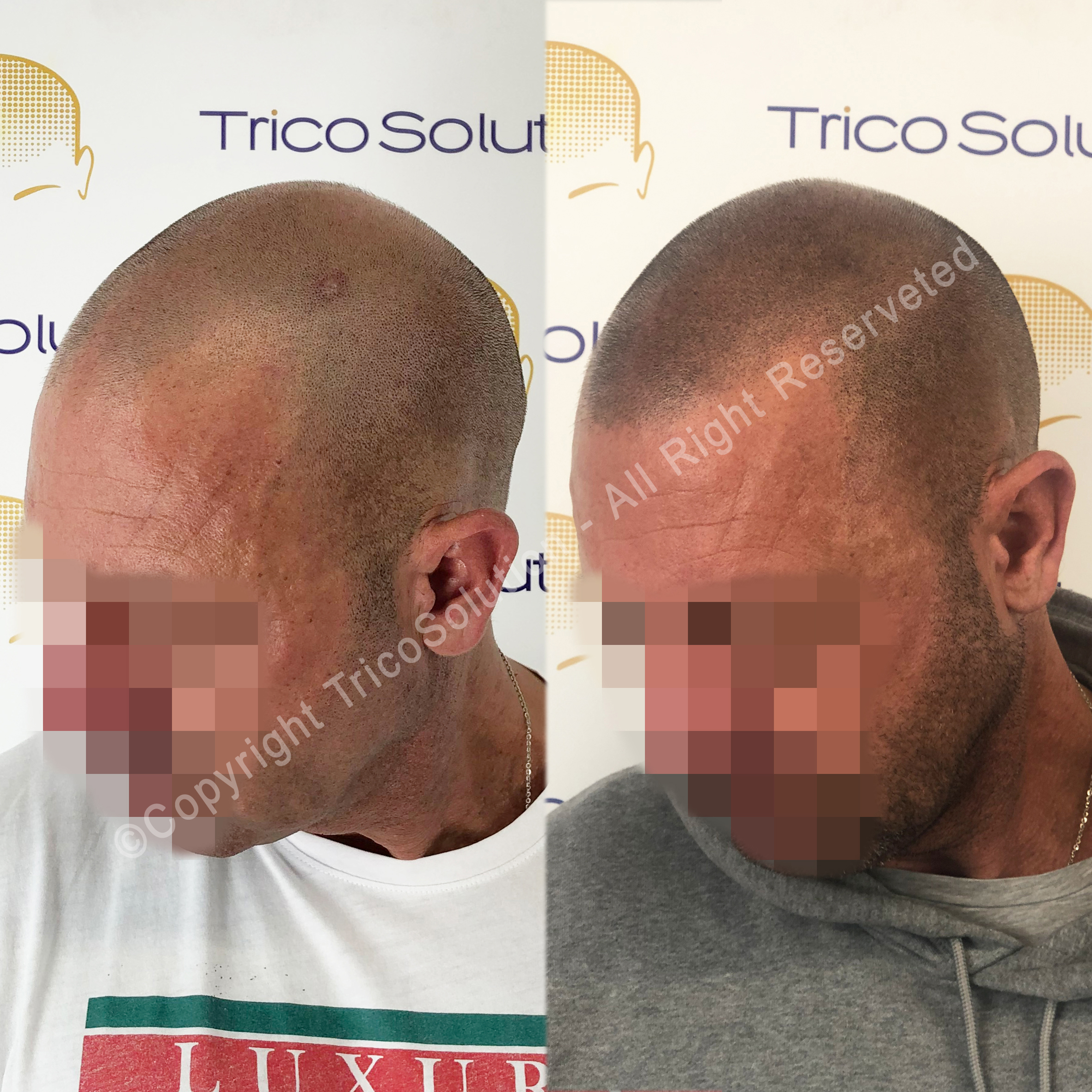 Effetto Rasato โ TricoSolution