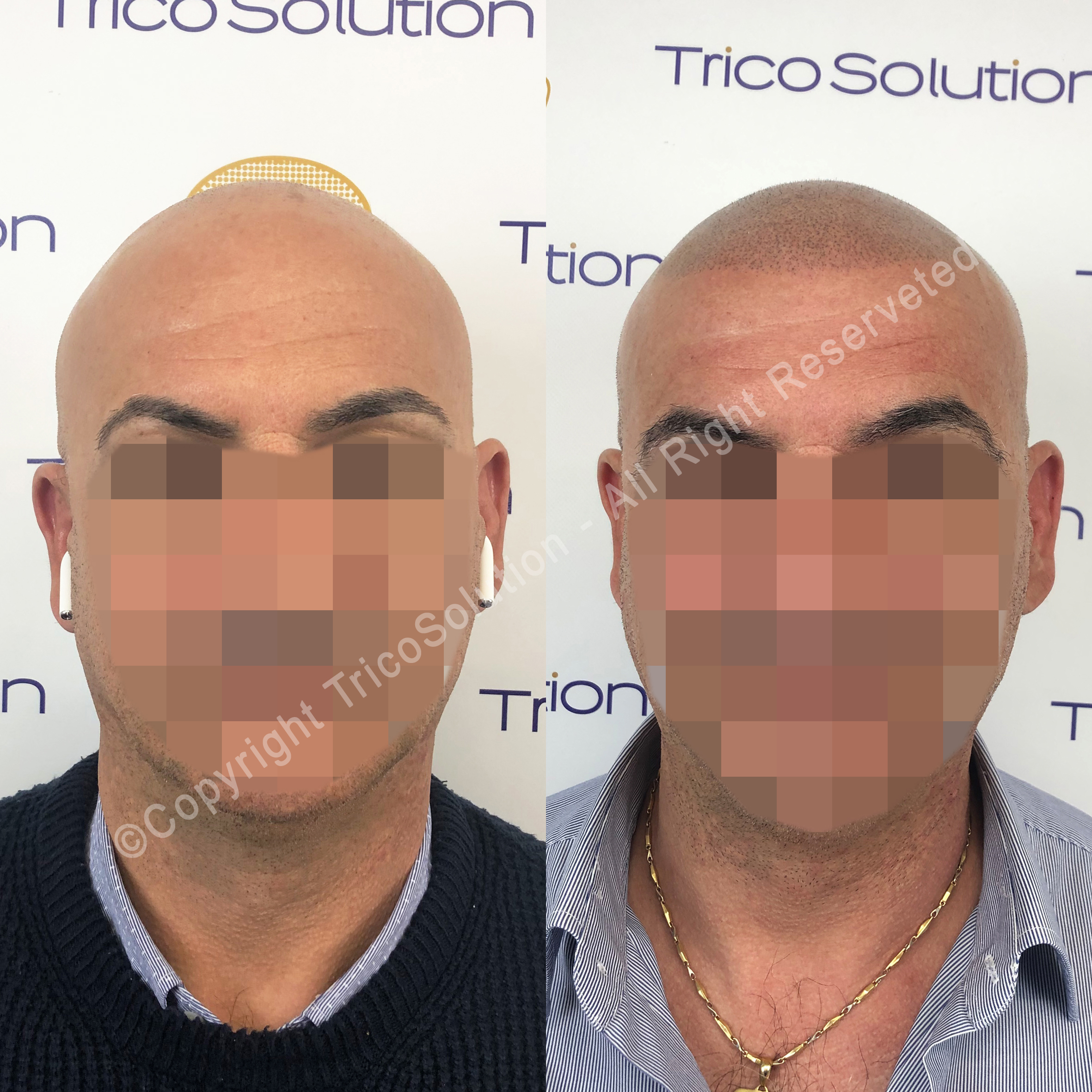 Effetto Rasato โ TricoSolution