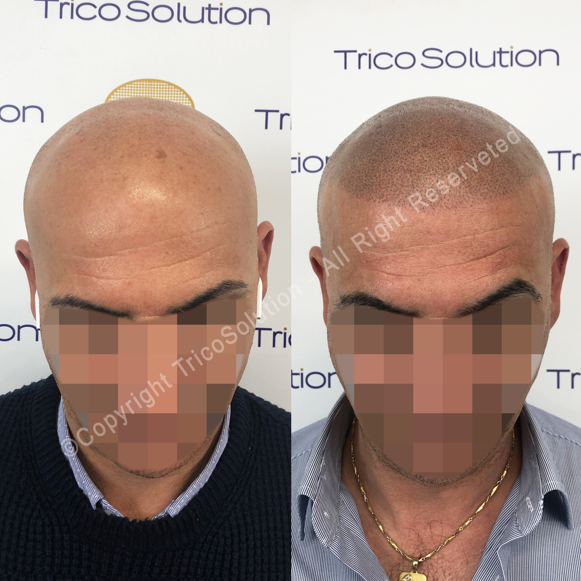 Effetto Rasato โ TricoSolution