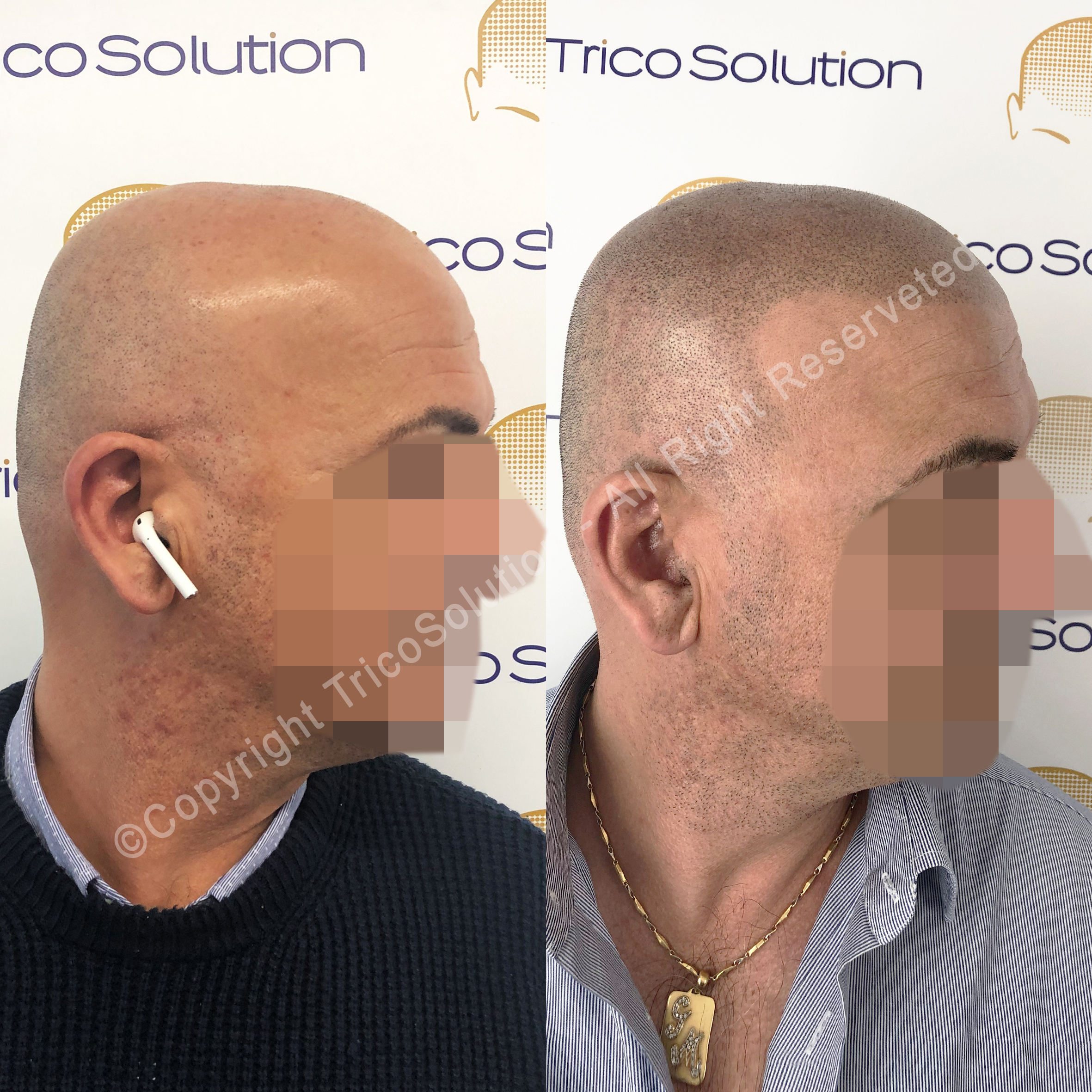 Effetto Rasato โ TricoSolution