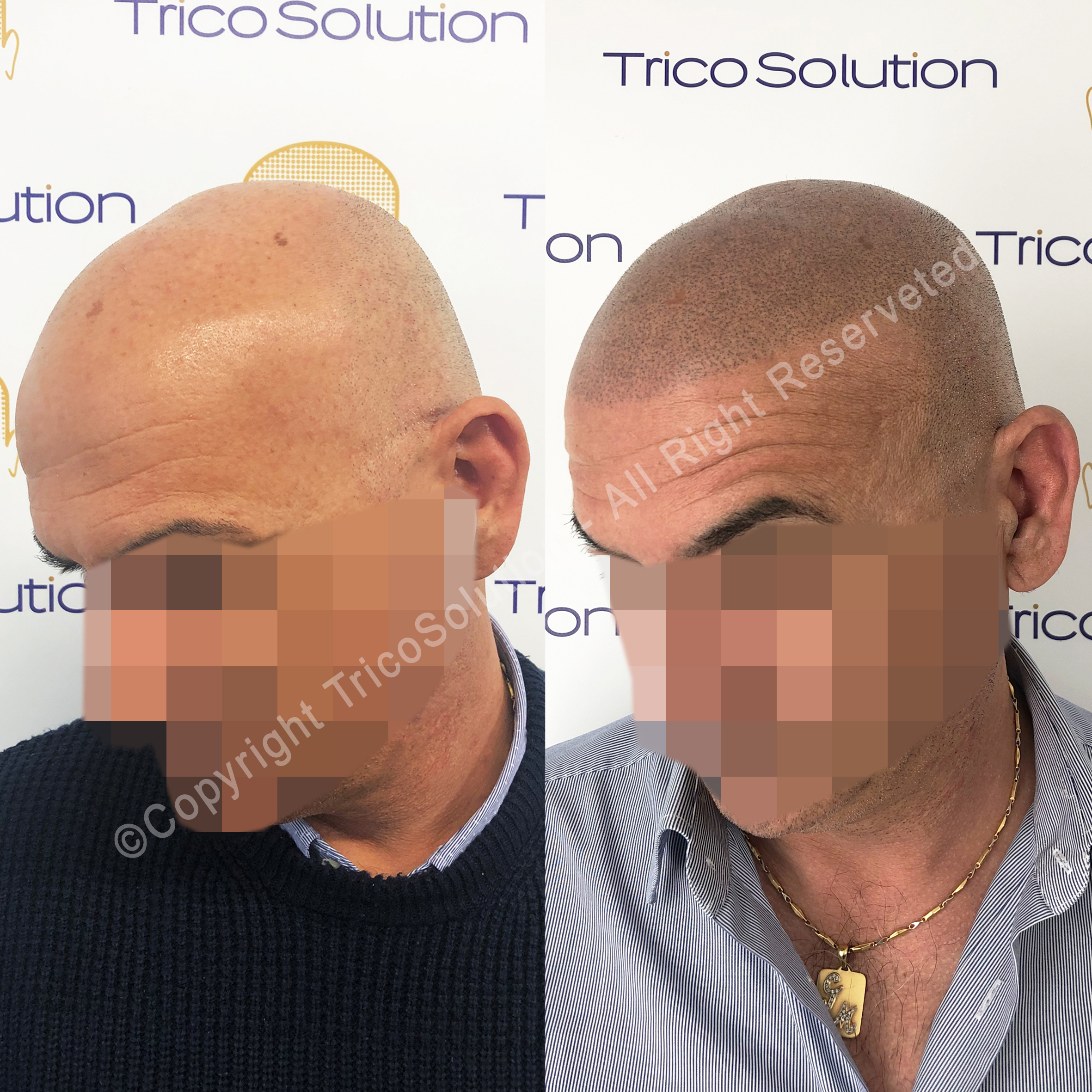 Effetto Rasato โ TricoSolution