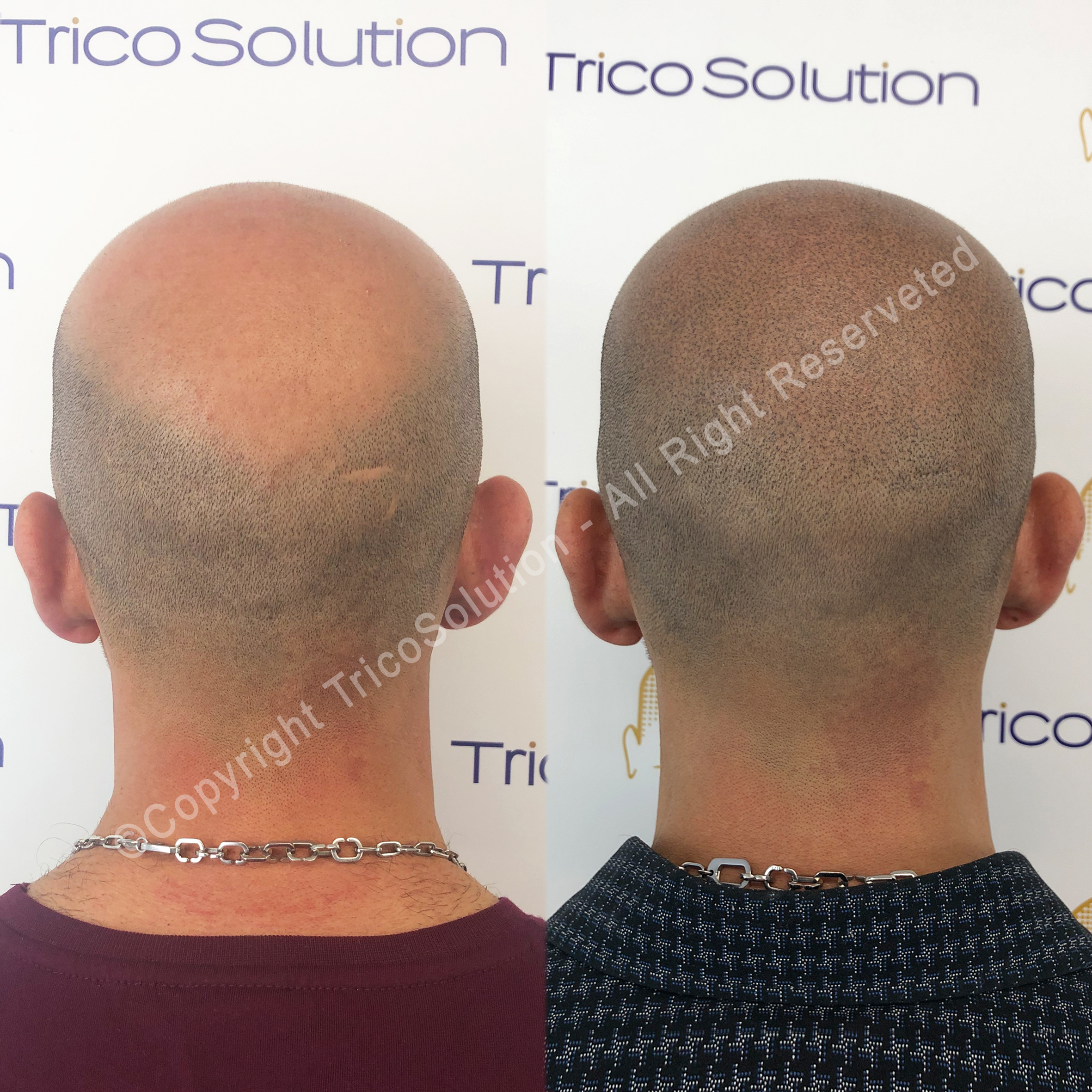 Effetto Rasato โ TricoSolution