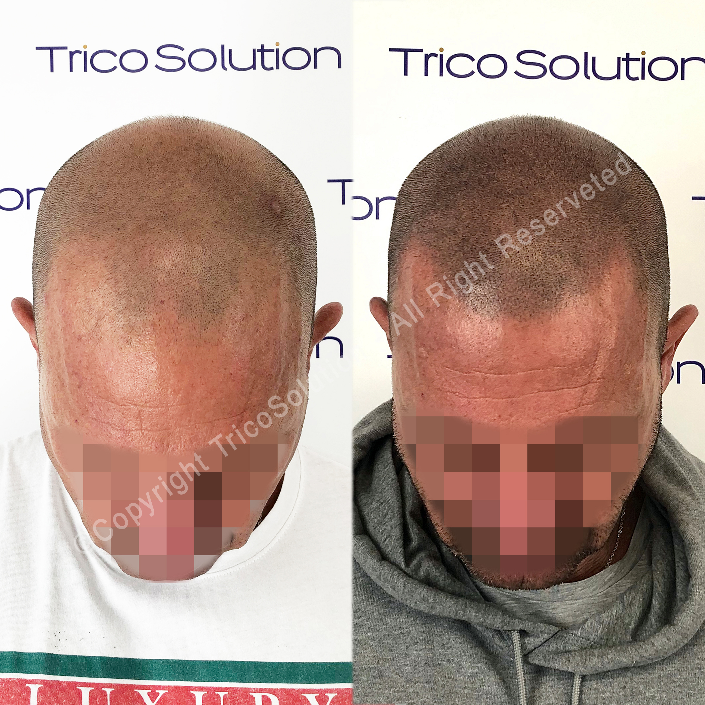 Effetto Rasato โ TricoSolution