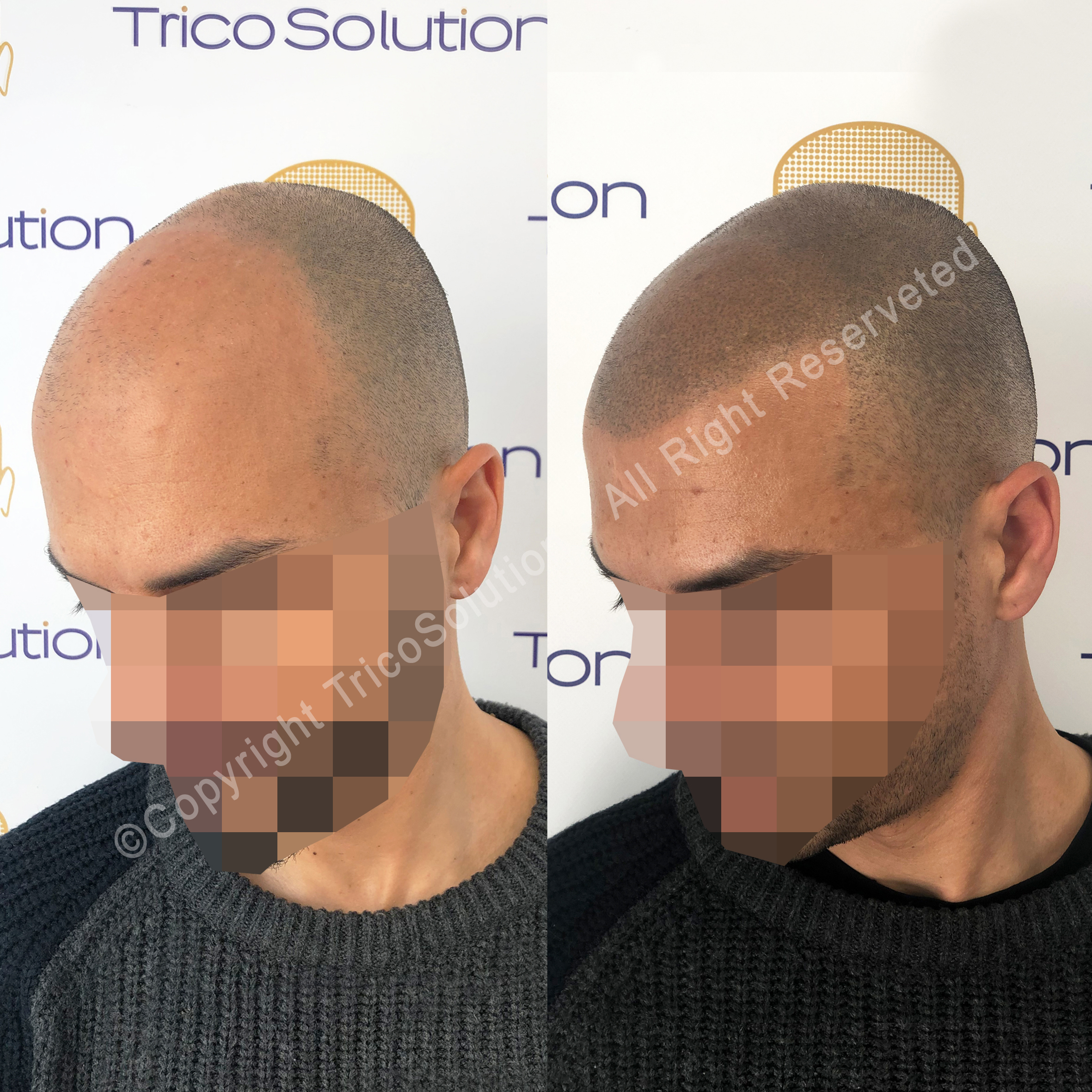 Effetto Rasato โ TricoSolution