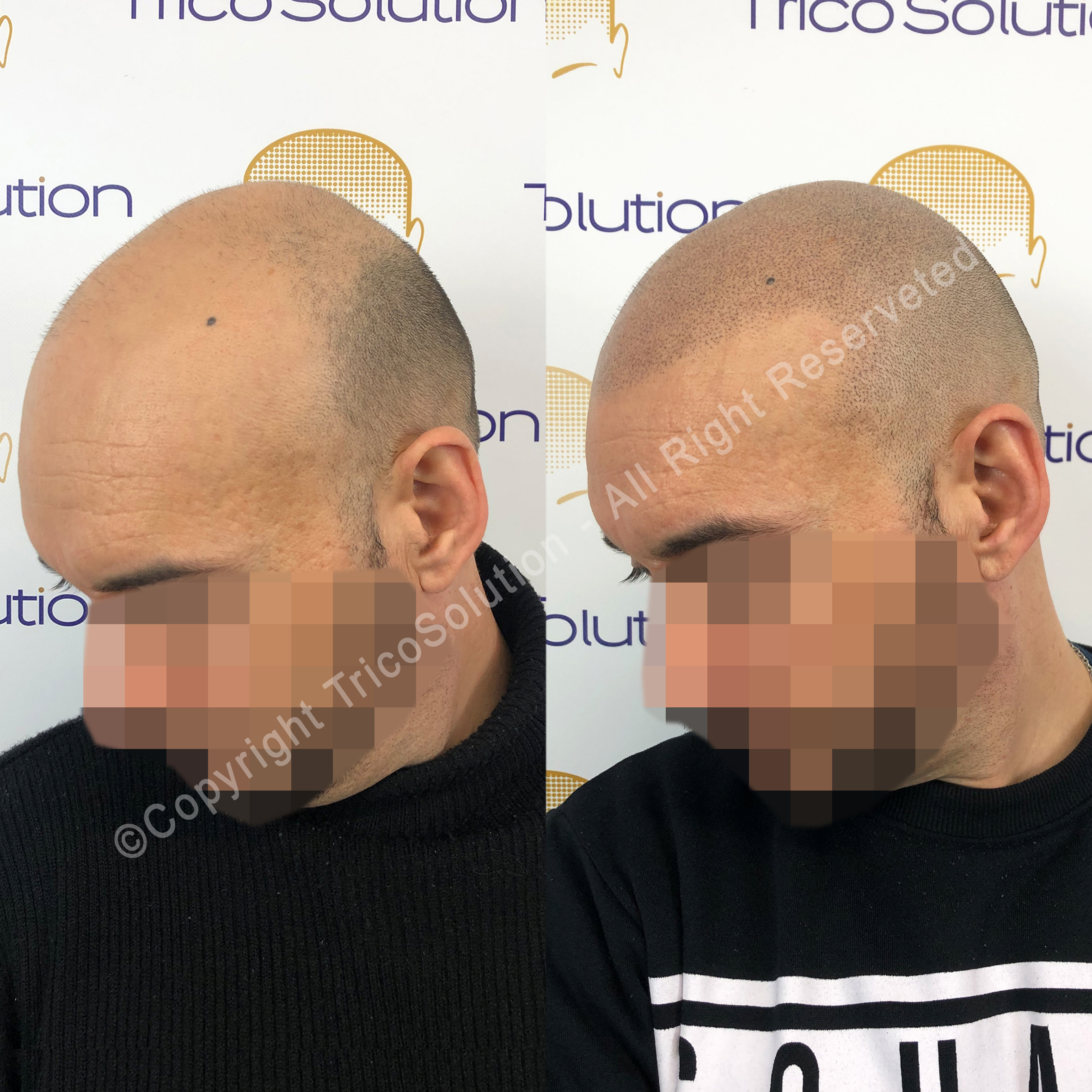 Effetto Rasato โ TricoSolution