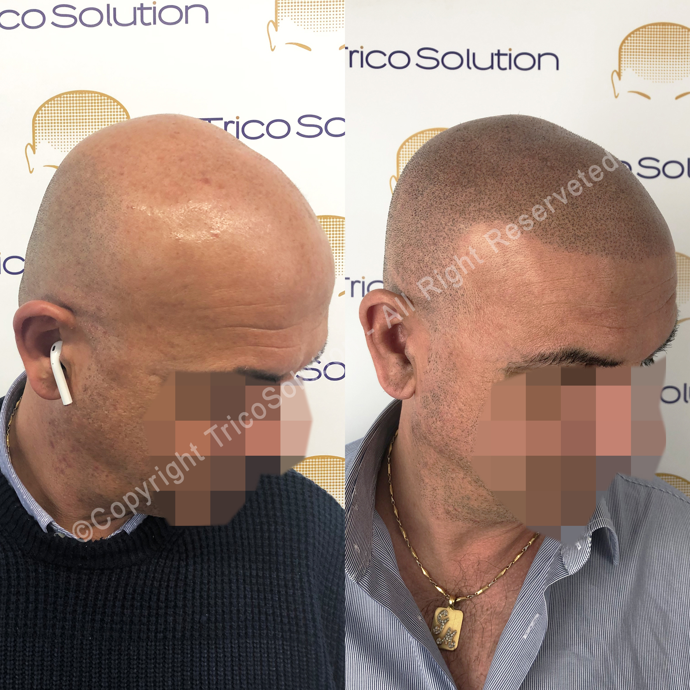 Effetto Rasato โ TricoSolution
