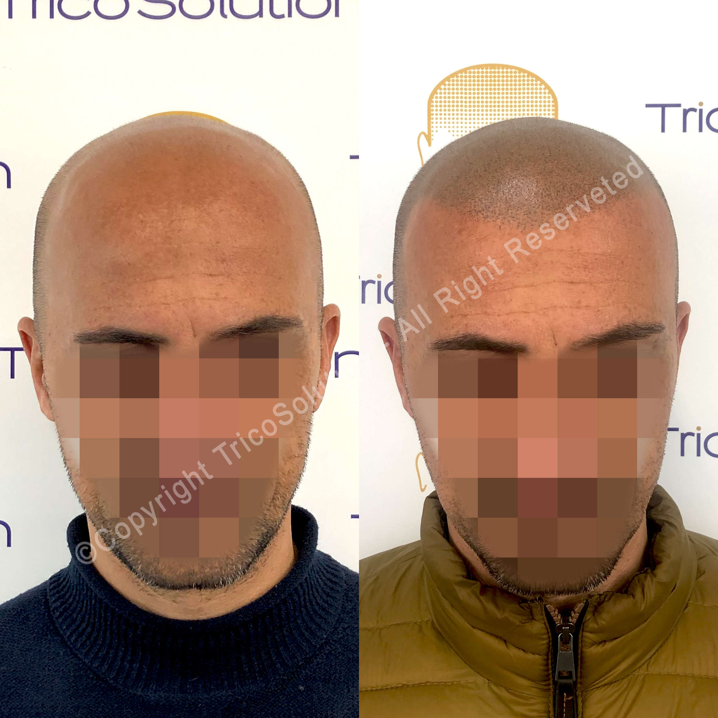 Effetto Rasato โ TricoSolution