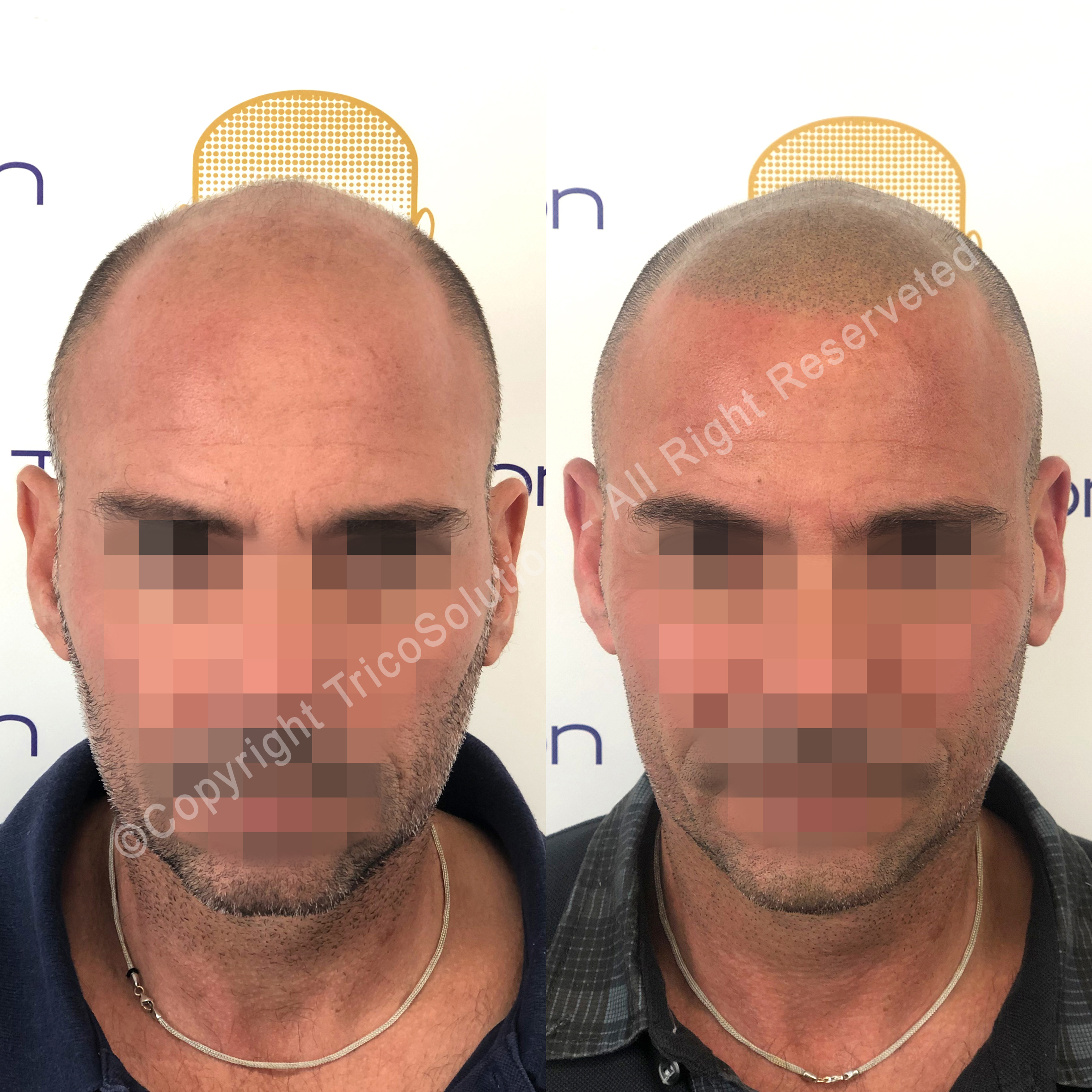 Effetto Rasato โ TricoSolution