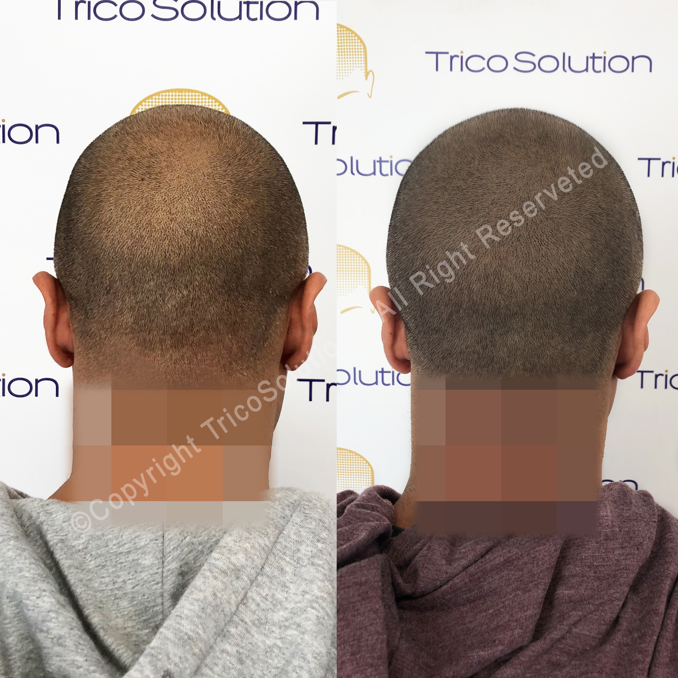 Effetto Rasato โ TricoSolution