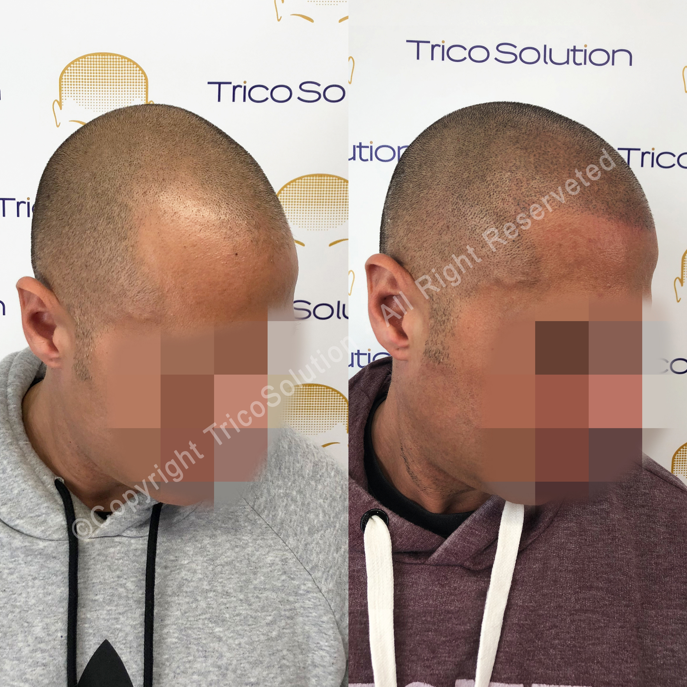 Effetto Rasato โ TricoSolution