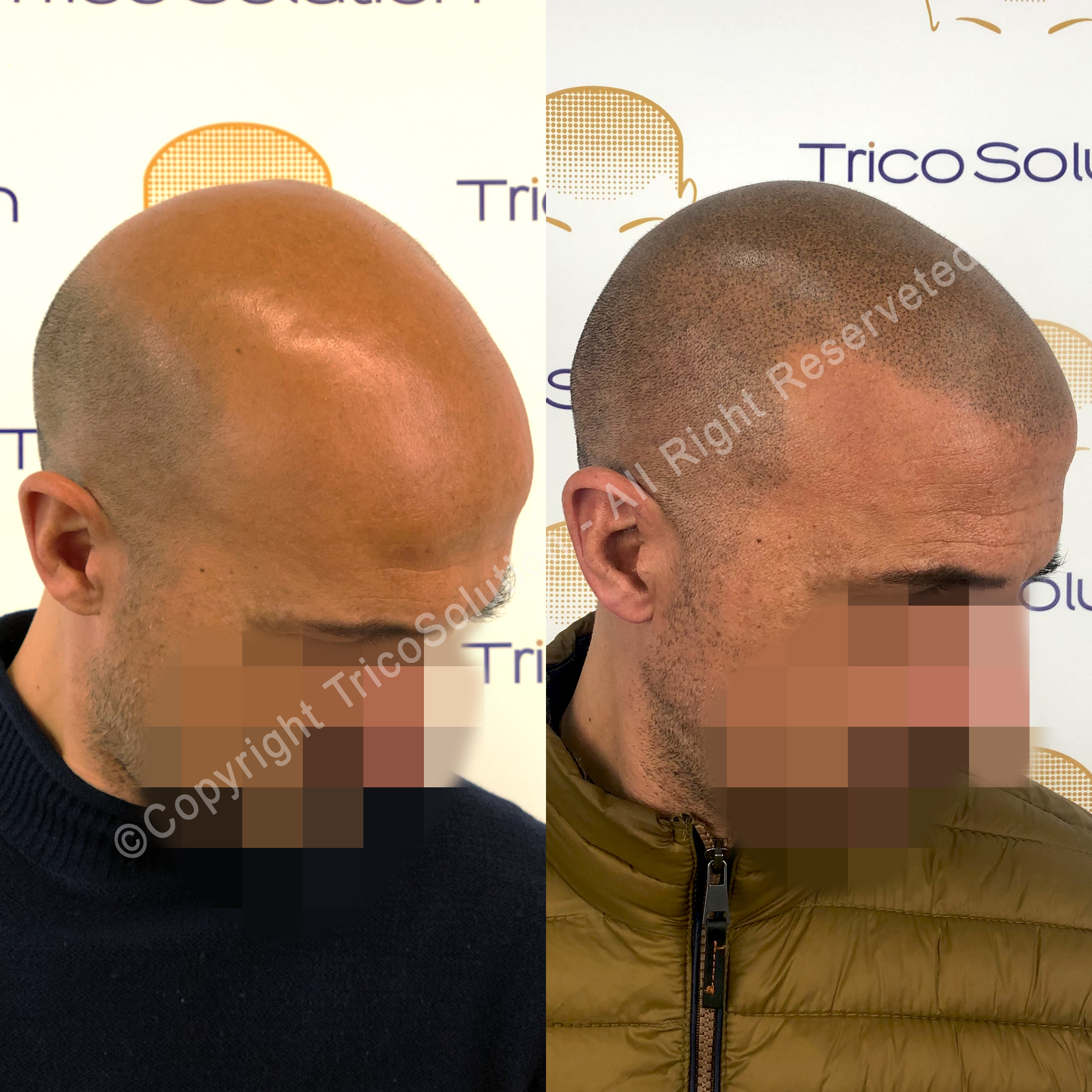 Effetto Rasato โ TricoSolution