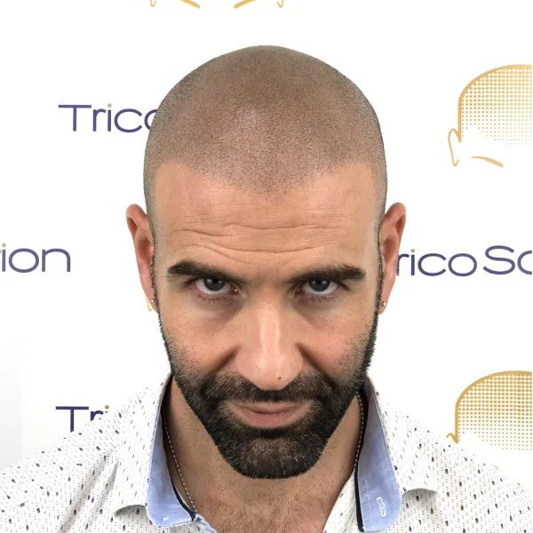 Effetto Rasato — TricoSolution
