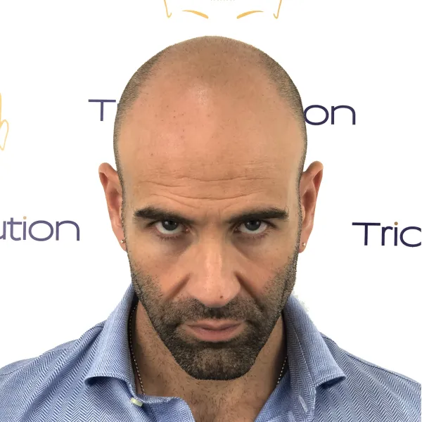 Effetto Rasato — TricoSolution