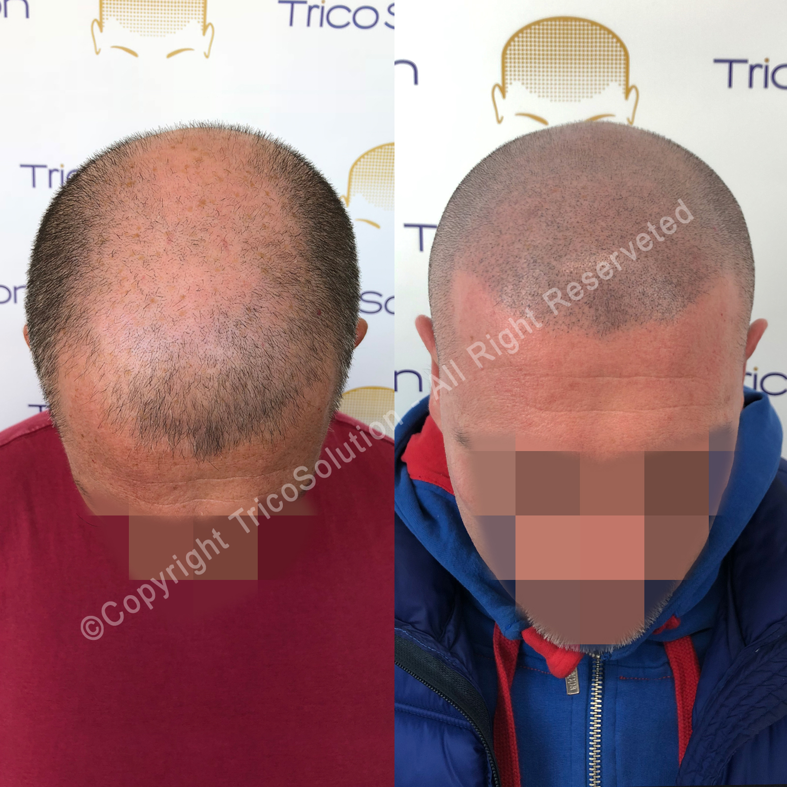 Effetto Rasato โ TricoSolution