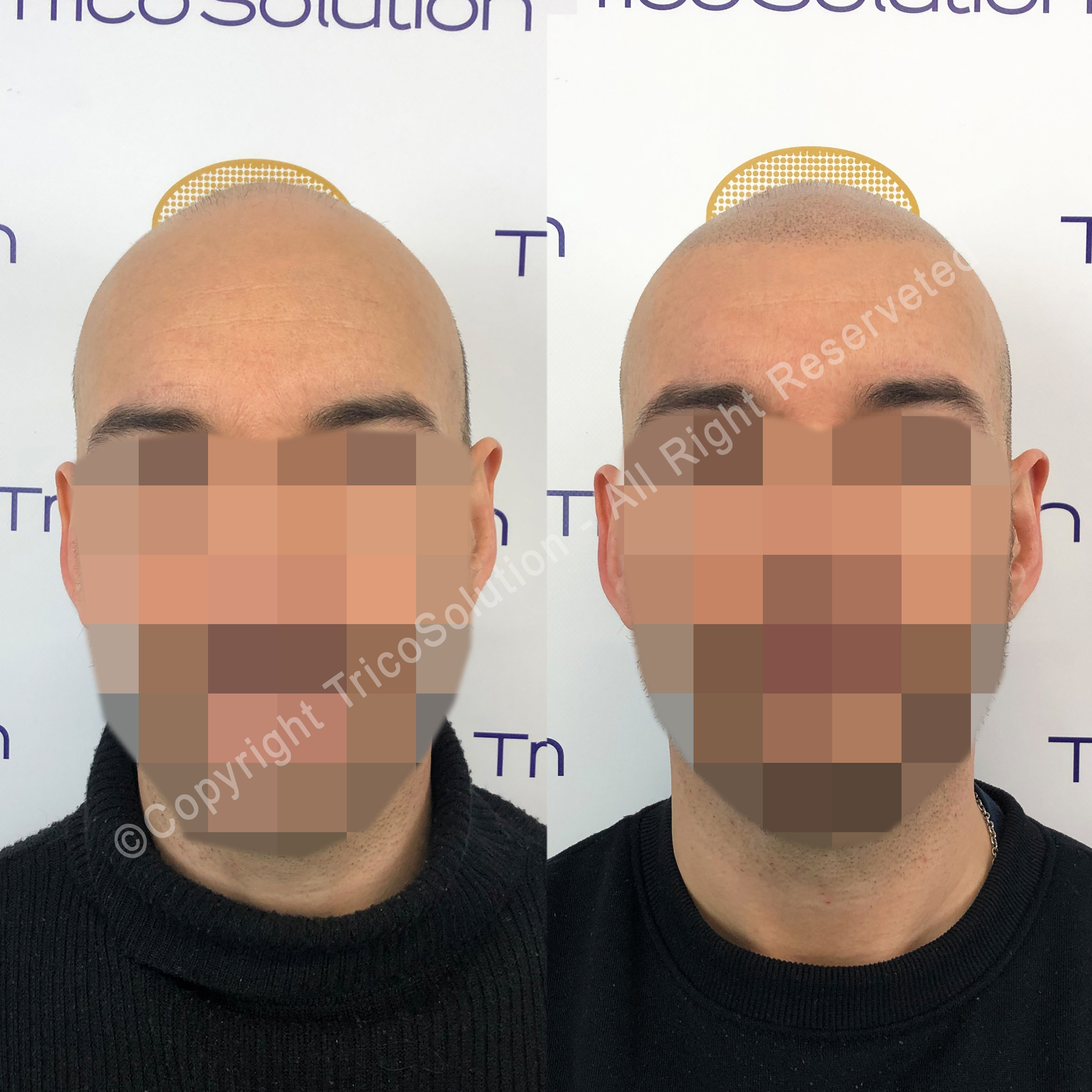 Effetto Rasato โ TricoSolution