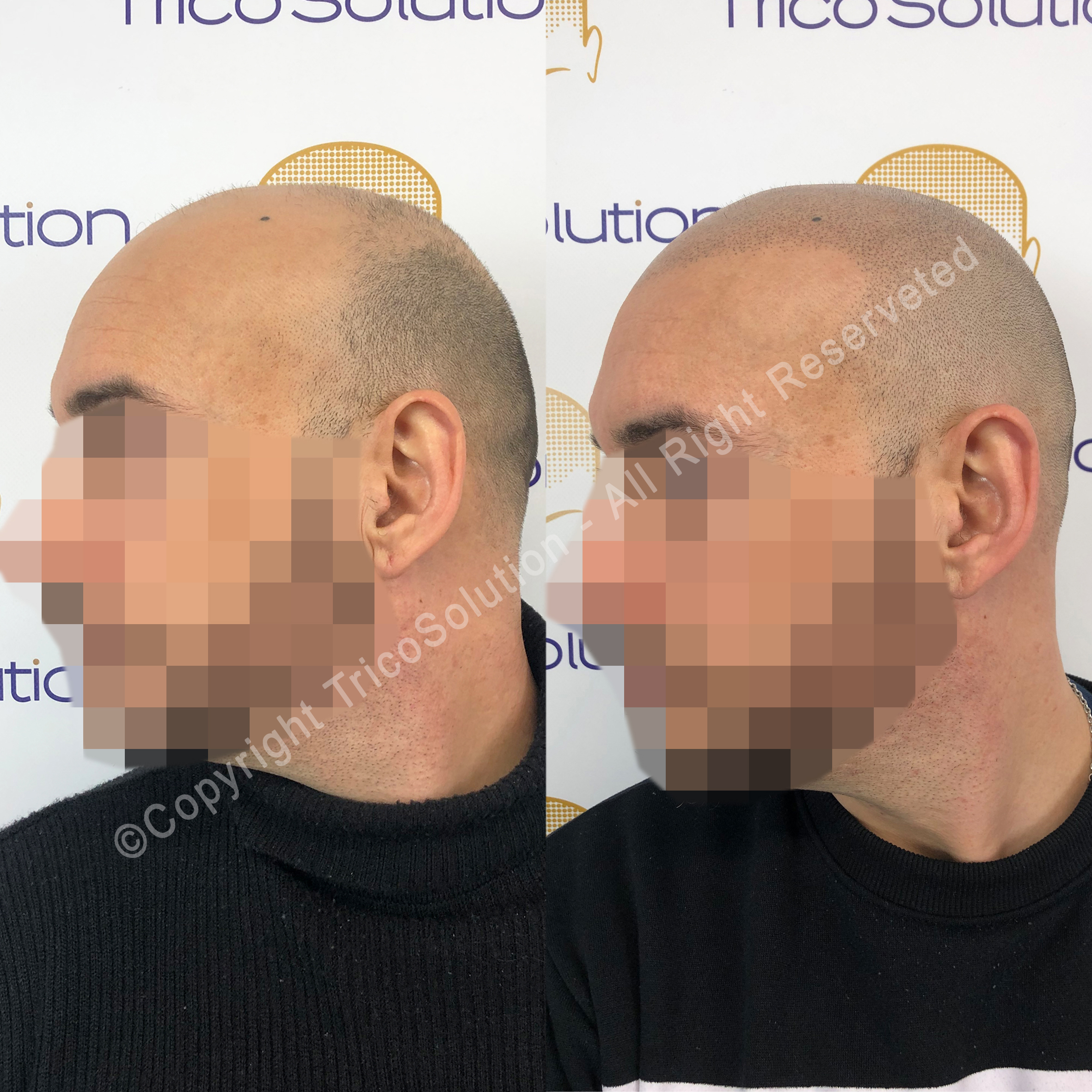 Effetto Rasato โ TricoSolution