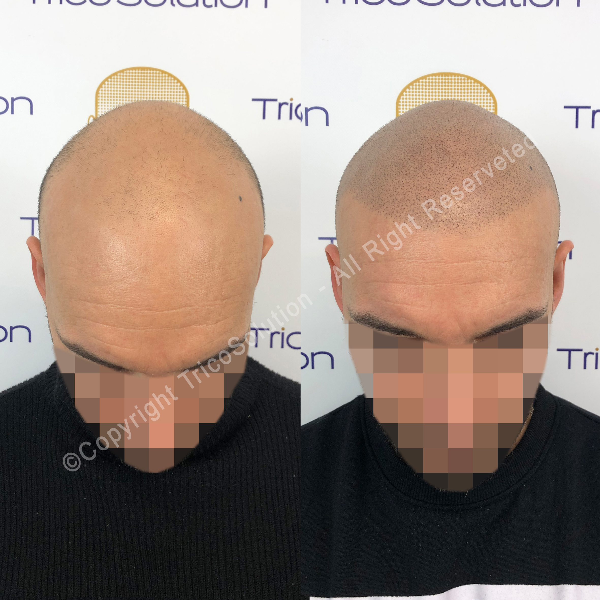 Effetto Rasato โ TricoSolution