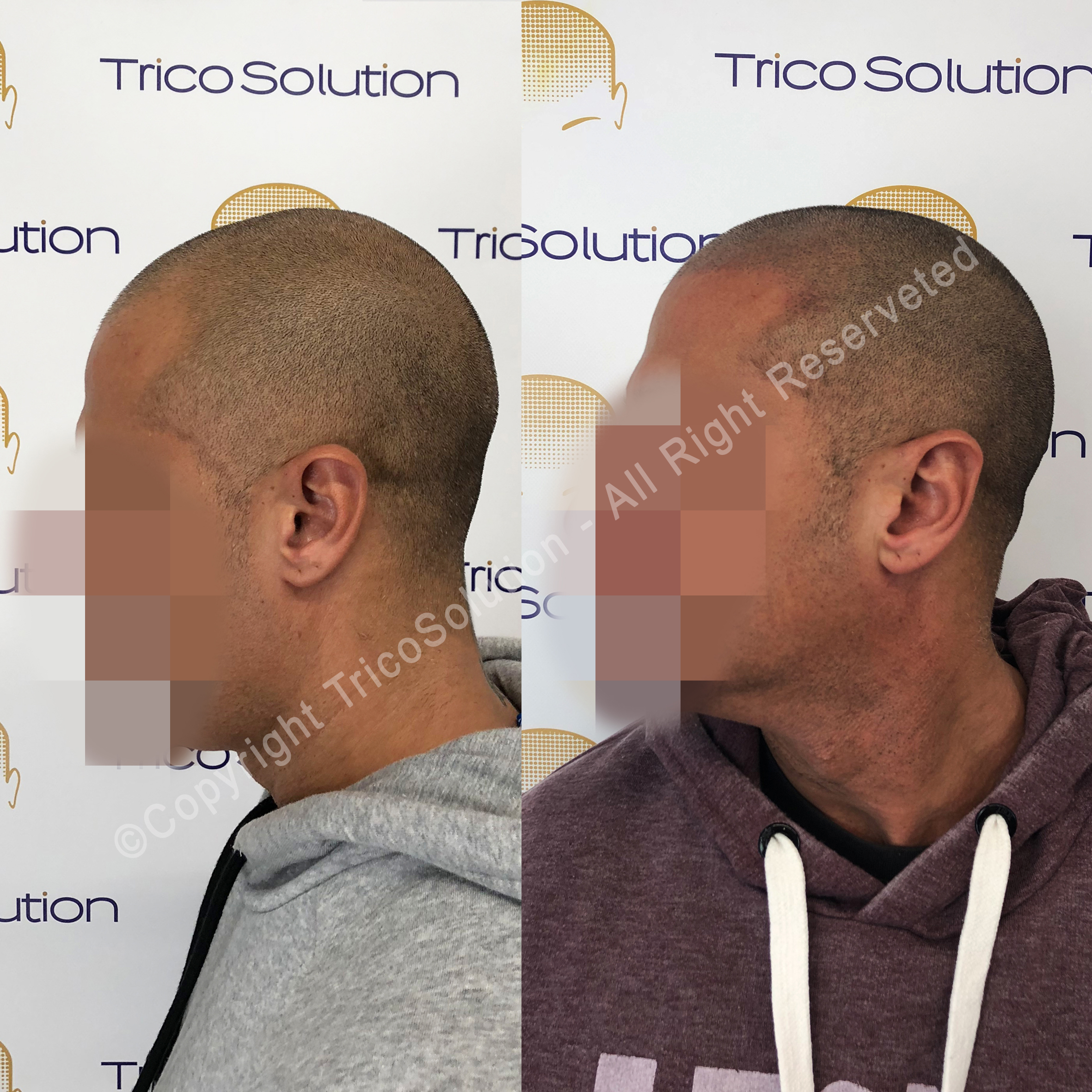 Effetto Rasato โ TricoSolution