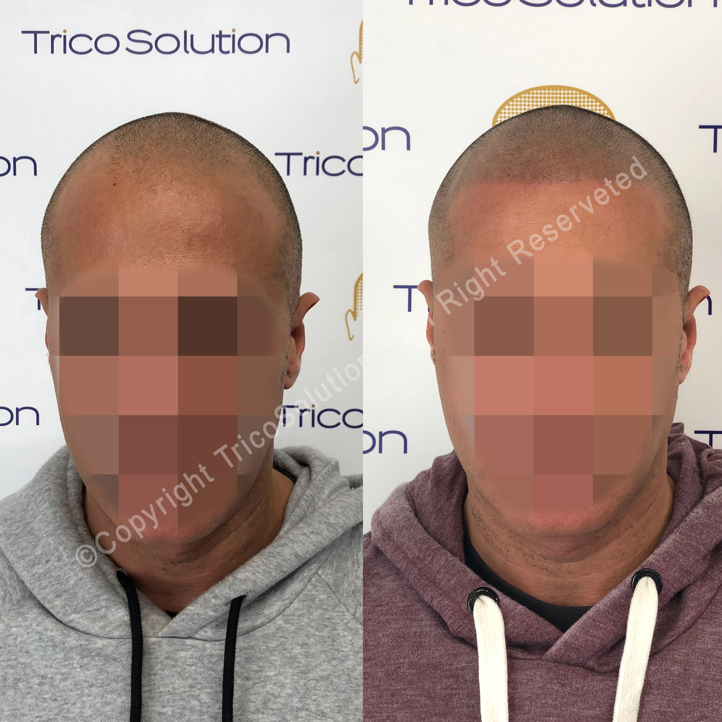 Effetto Rasato โ TricoSolution