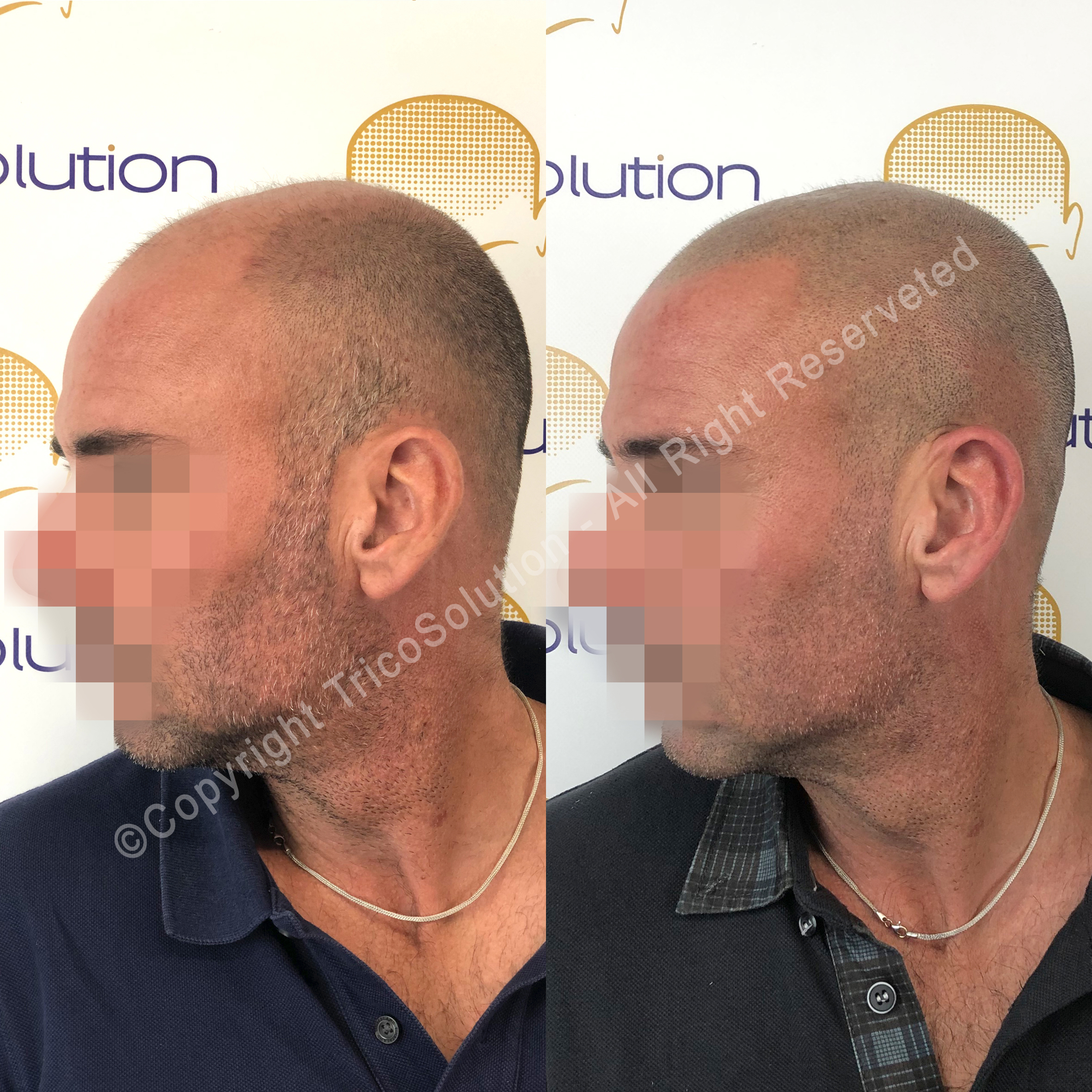 Effetto Rasato โ TricoSolution