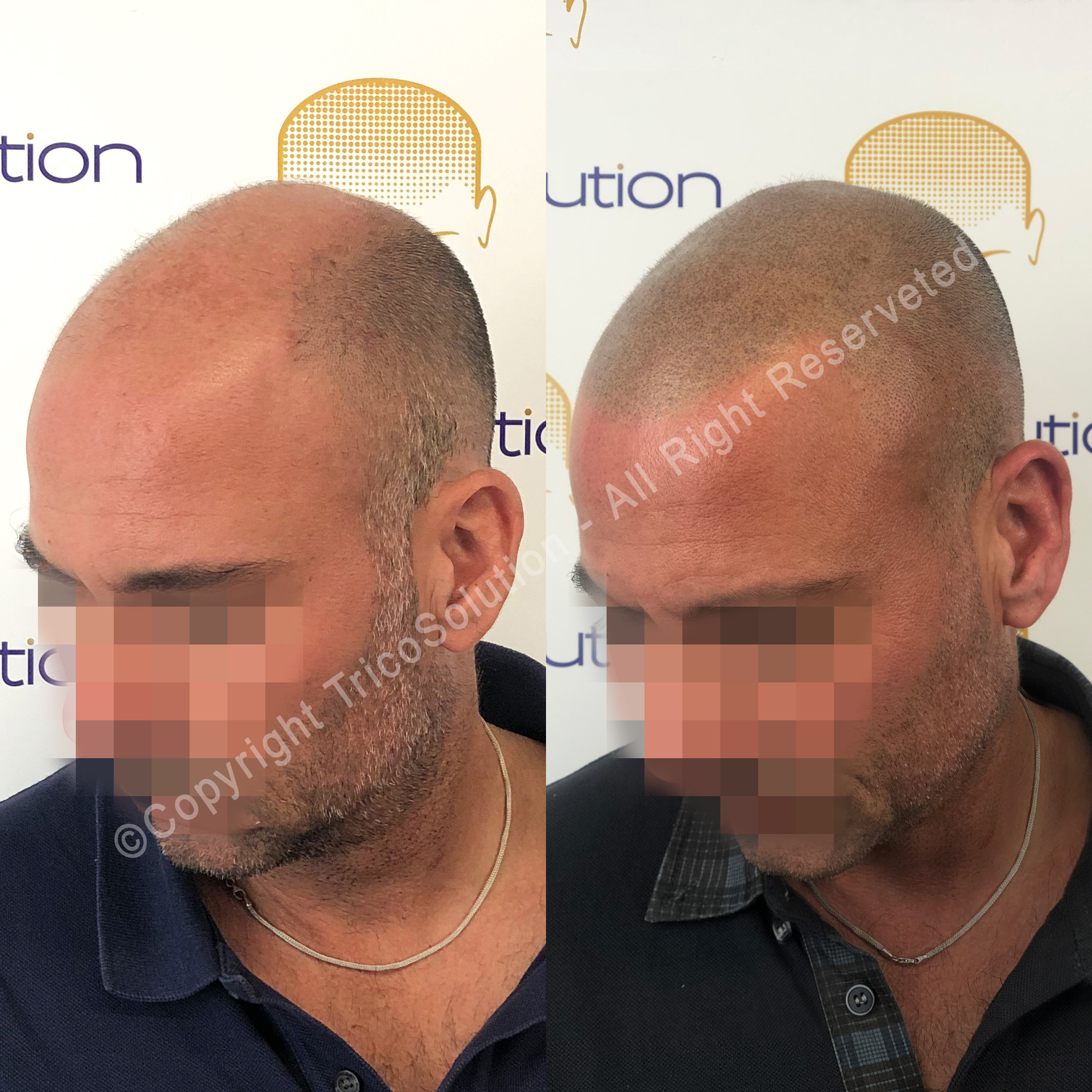Effetto Rasato โ TricoSolution